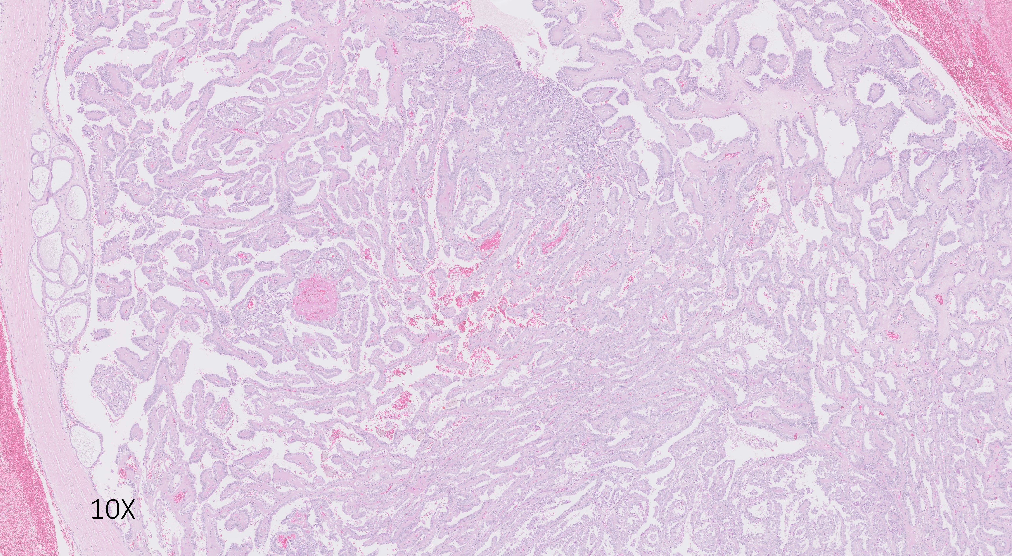 Microscopic image possibly detecting cancerous areas in human tissue