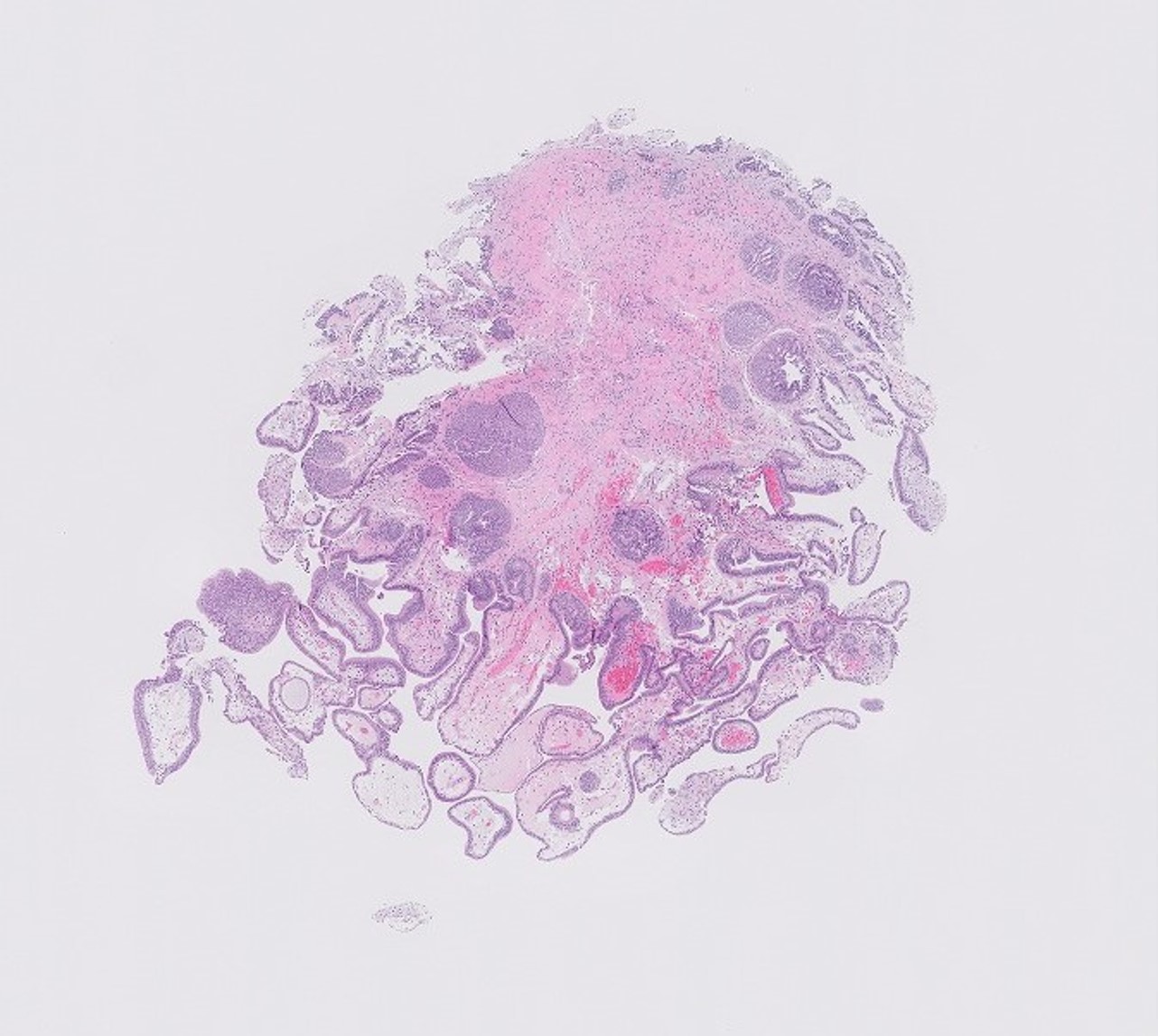 Microscopic image possibly detecting cancerous areas in human tissue