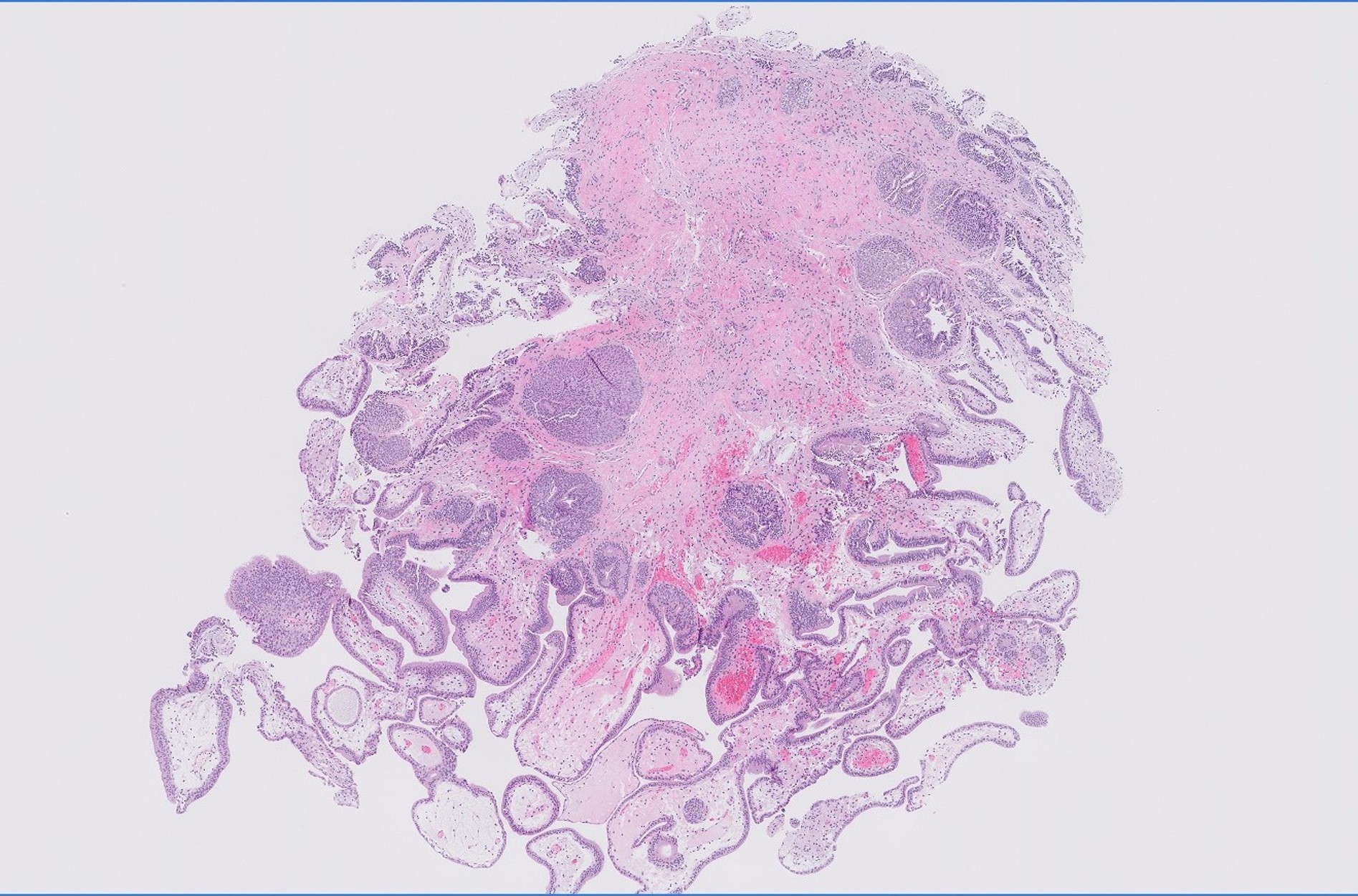 Microscopic image possibly detecting cancerous areas in human tissue