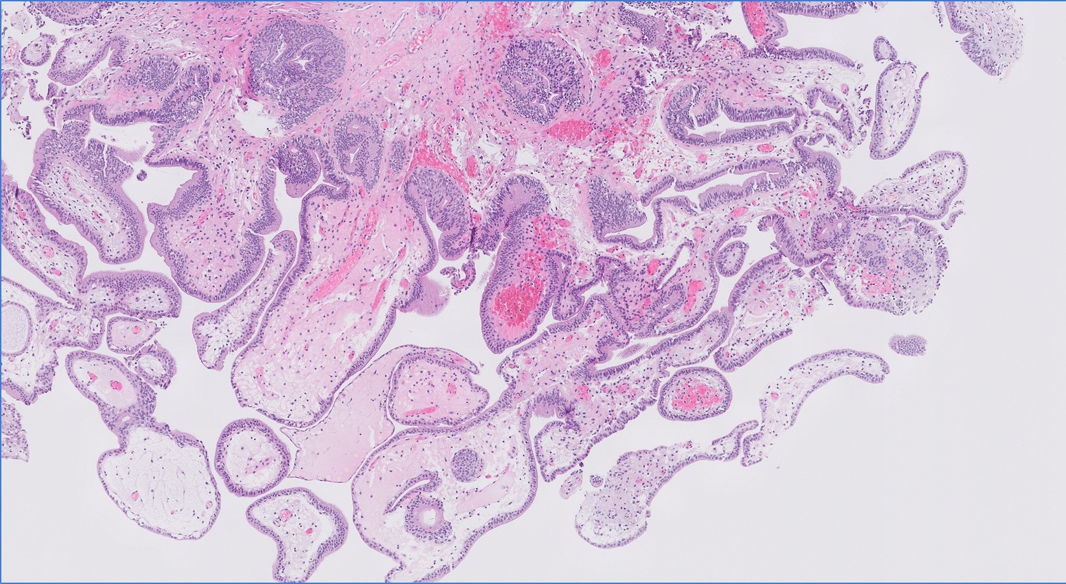 Microscopic image possibly detecting cancerous areas in human tissue