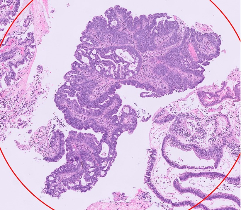 Microscopic image possibly detecting cancerous areas in human tissue