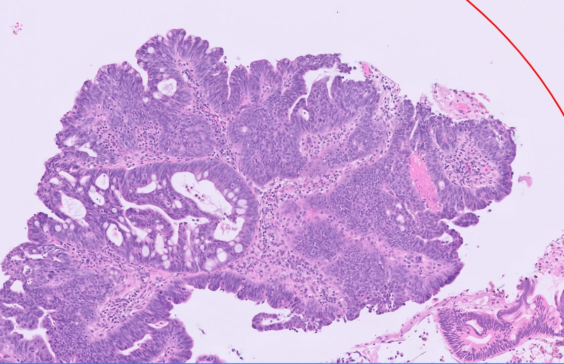 Microscopic image possibly detecting cancerous areas in human tissue