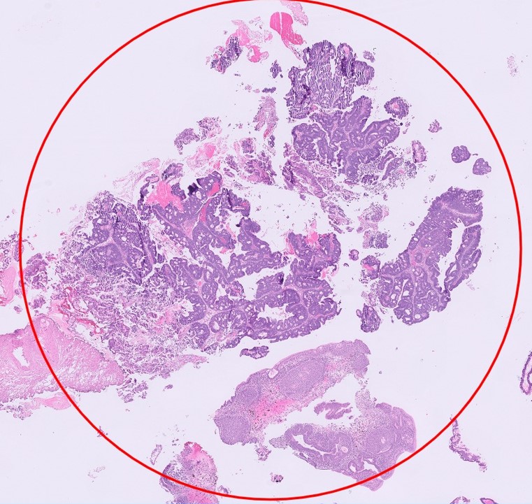 Microscopic image possibly detecting cancerous areas in human tissue