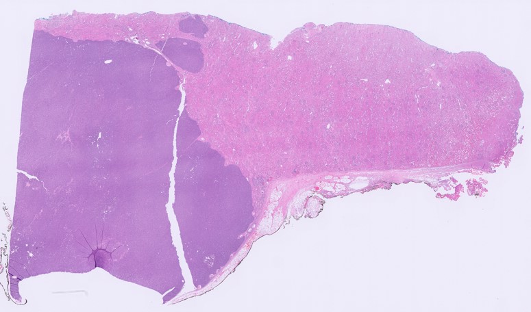 Microscopic image possibly detecting cancerous areas in human tissue