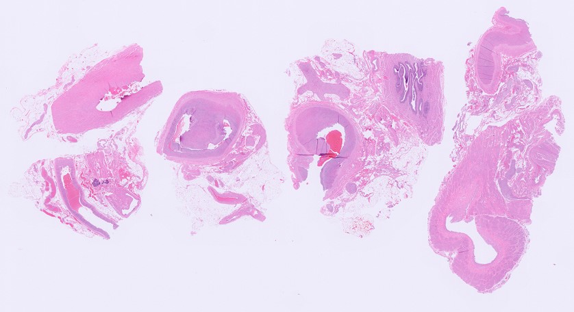 Microscopic image possibly detecting cancerous areas in human tissue