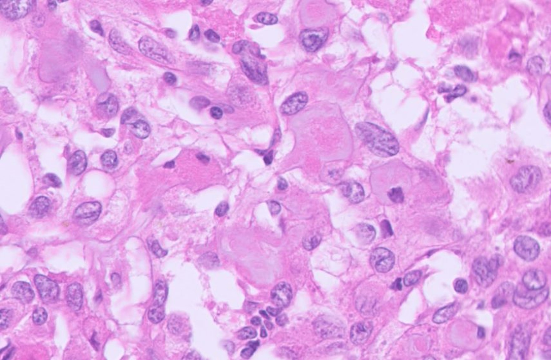 Microscopic image possibly detecting cancerous areas in human tissue