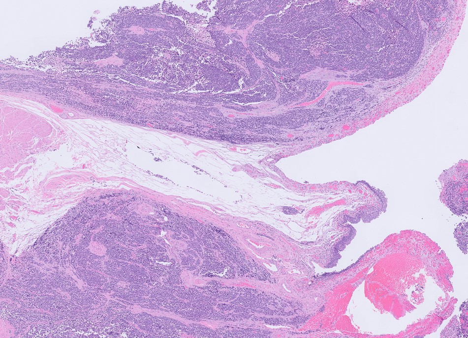 Microscopic image possibly detecting cancerous areas in human tissue