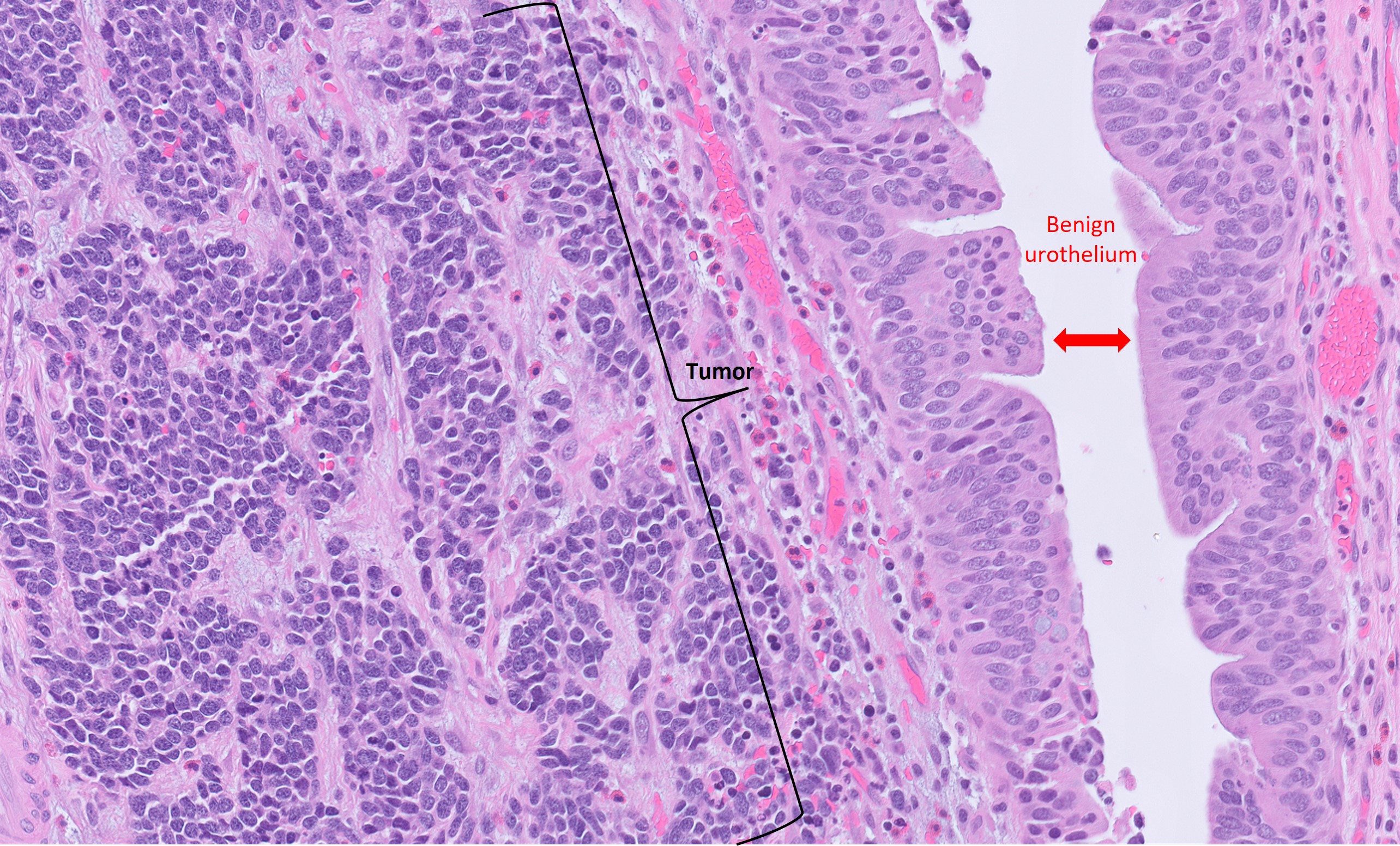 Microscopic image possibly detecting cancerous areas in human tissue