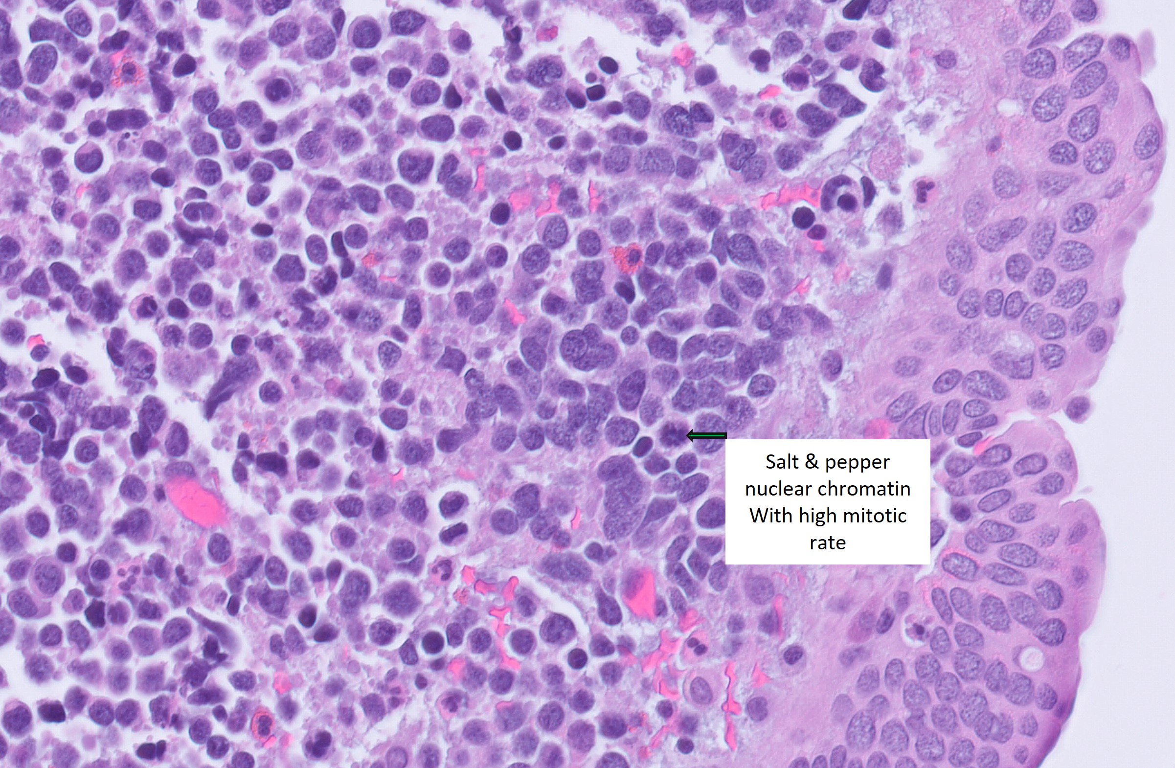 Microscopic image possibly detecting cancerous areas in human tissue