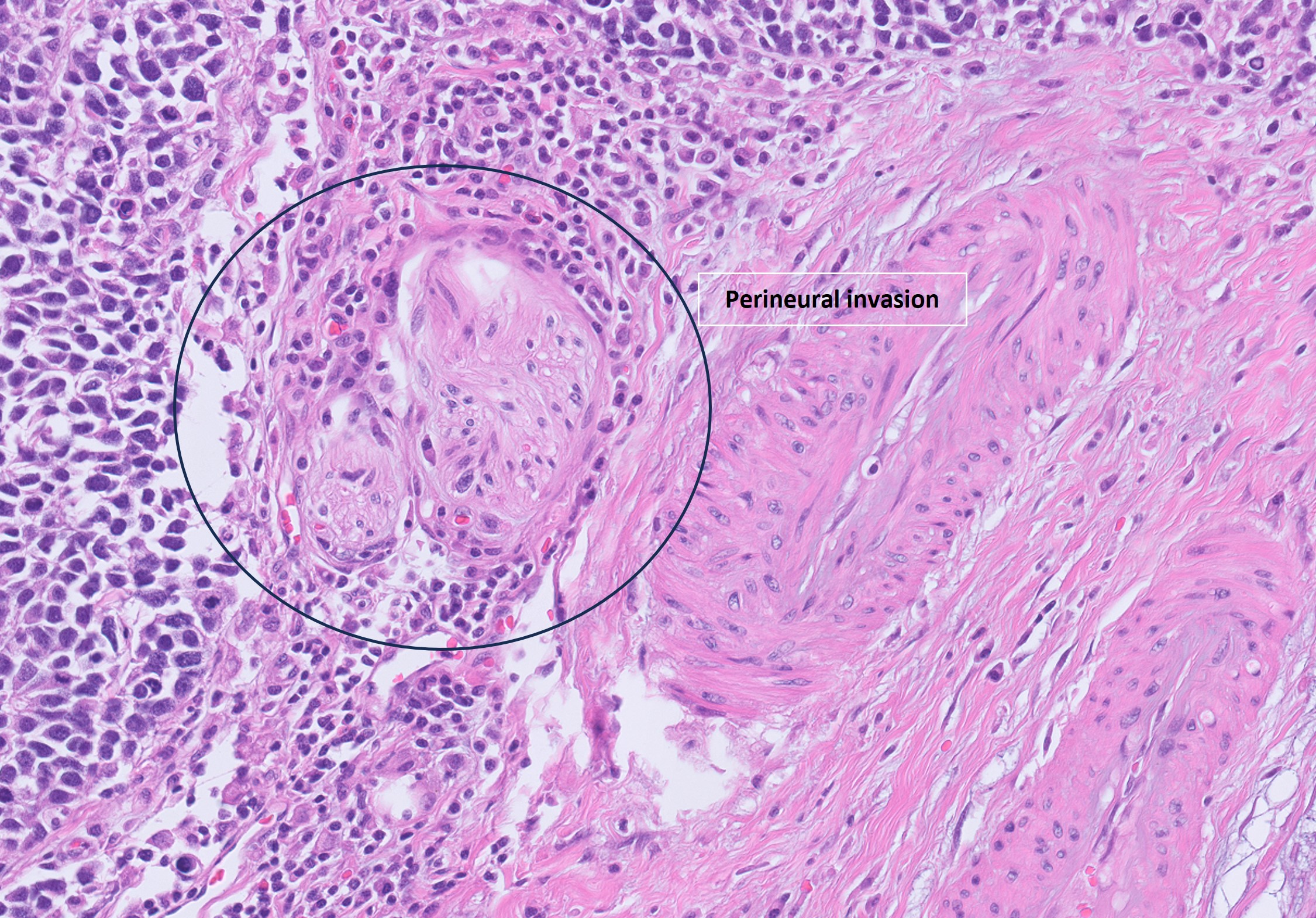 Microscopic image possibly detecting cancerous areas in human tissue