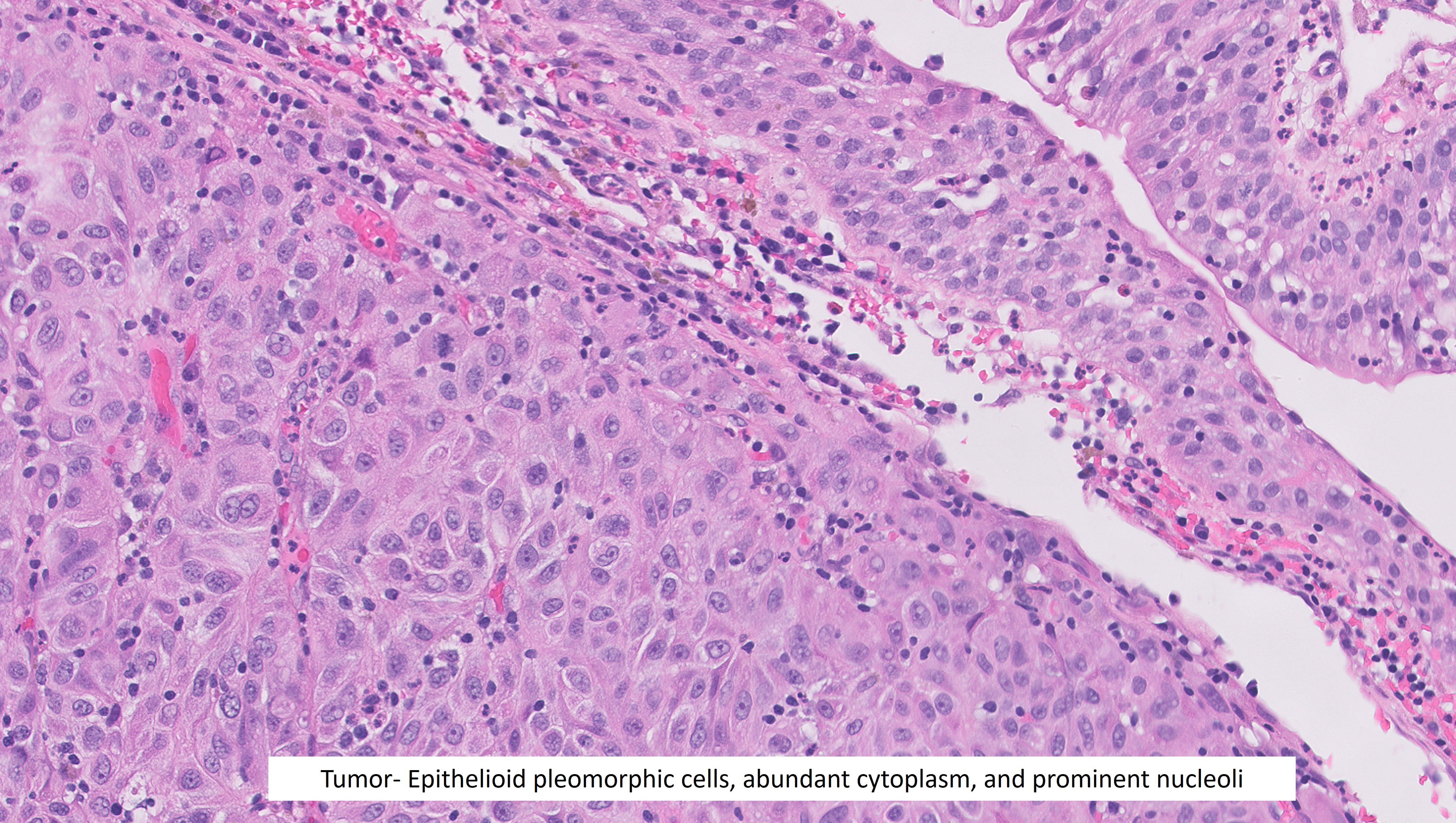 Microscopic image possibly detecting cancerous areas in human tissue