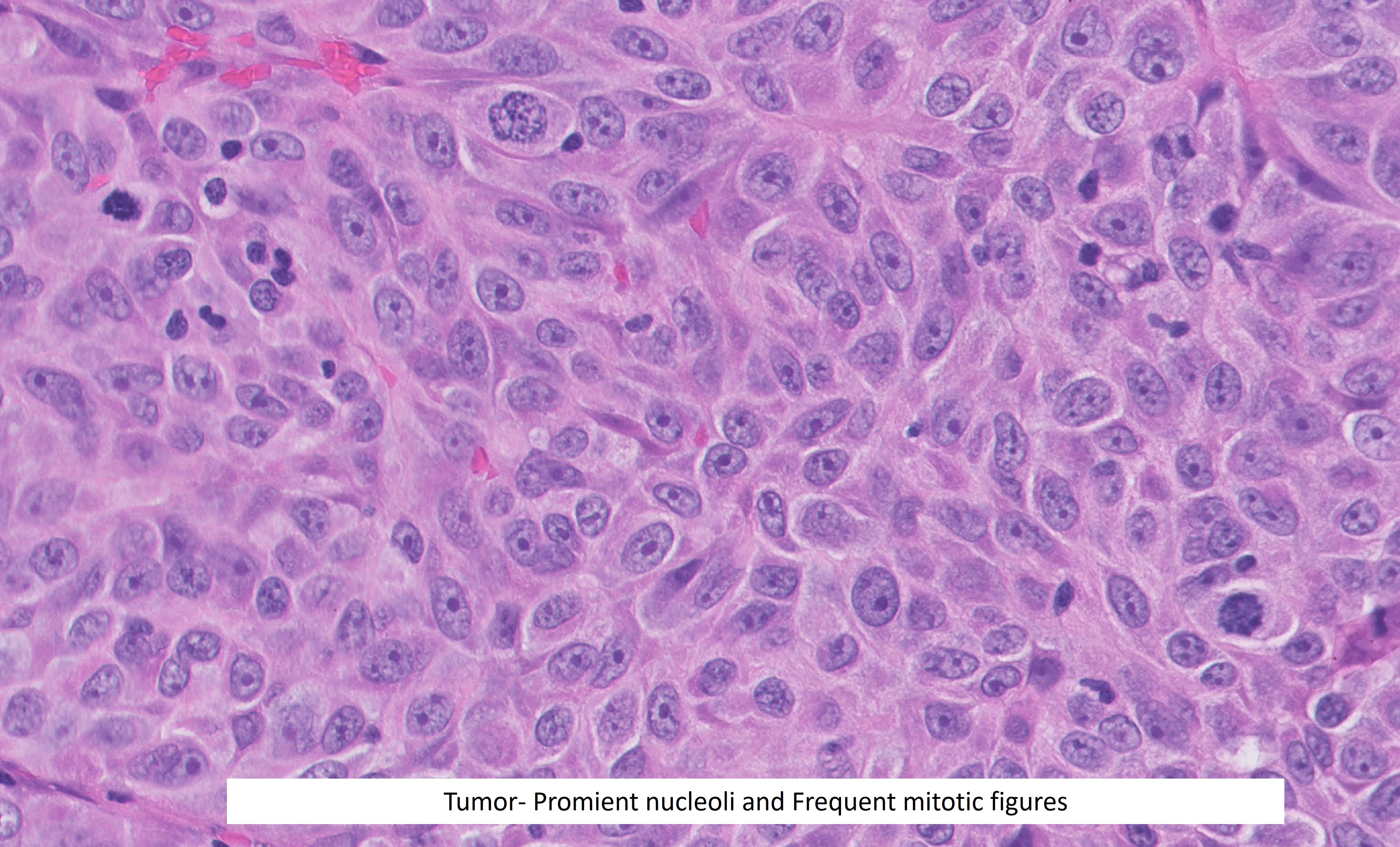 Microscopic image possibly detecting cancerous areas in human tissue