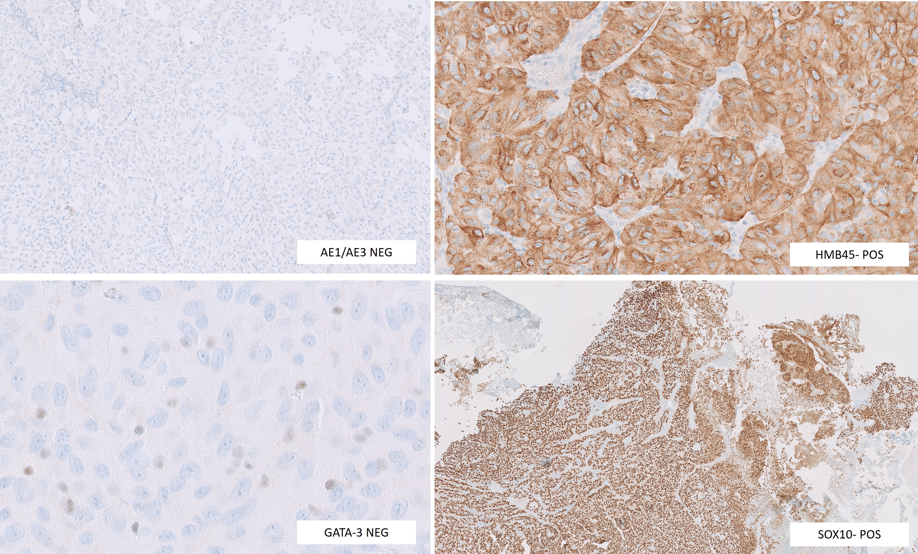 Microscopic image possibly detecting cancerous areas in human tissue