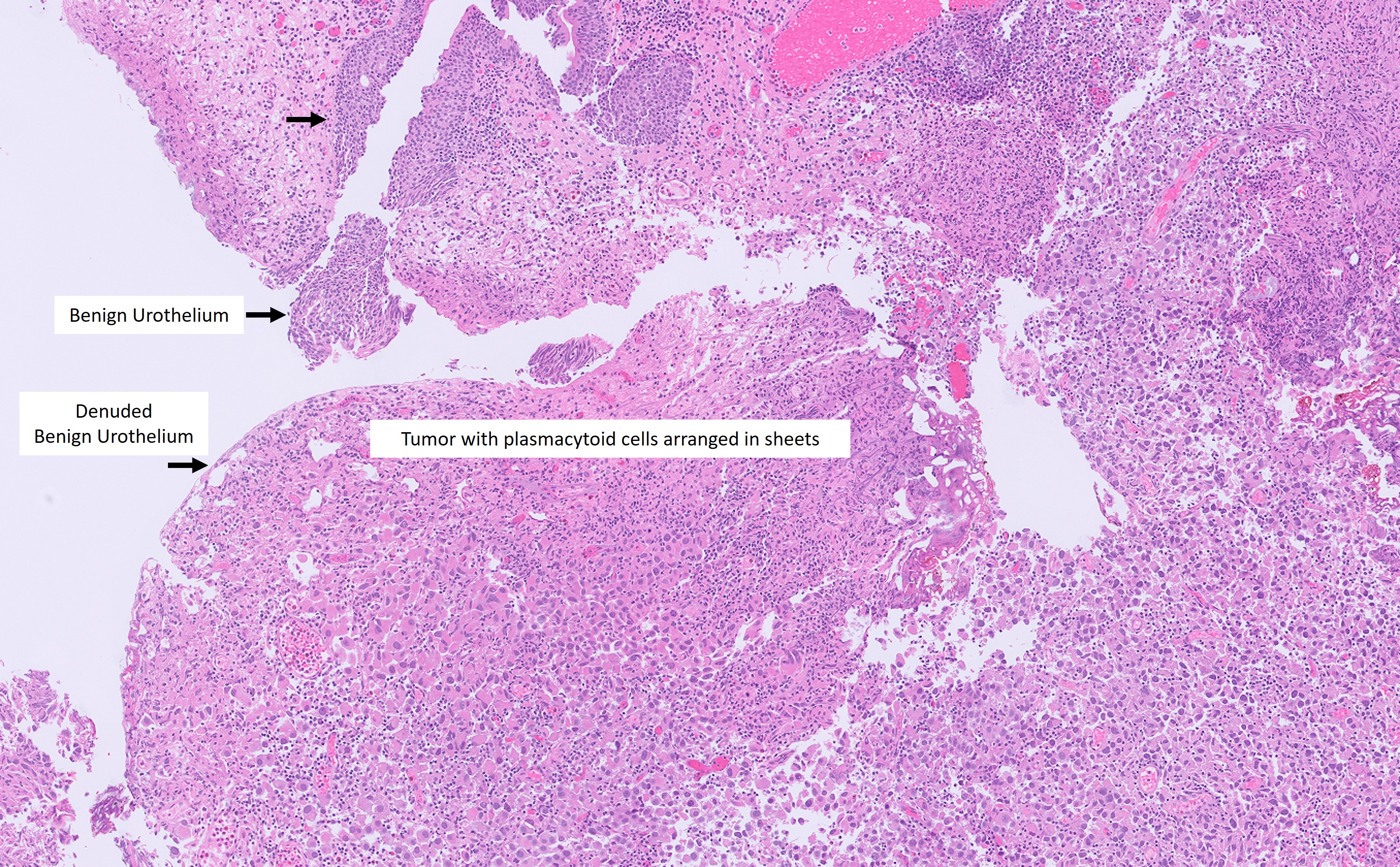 Microscopic image possibly detecting cancerous areas in human tissue