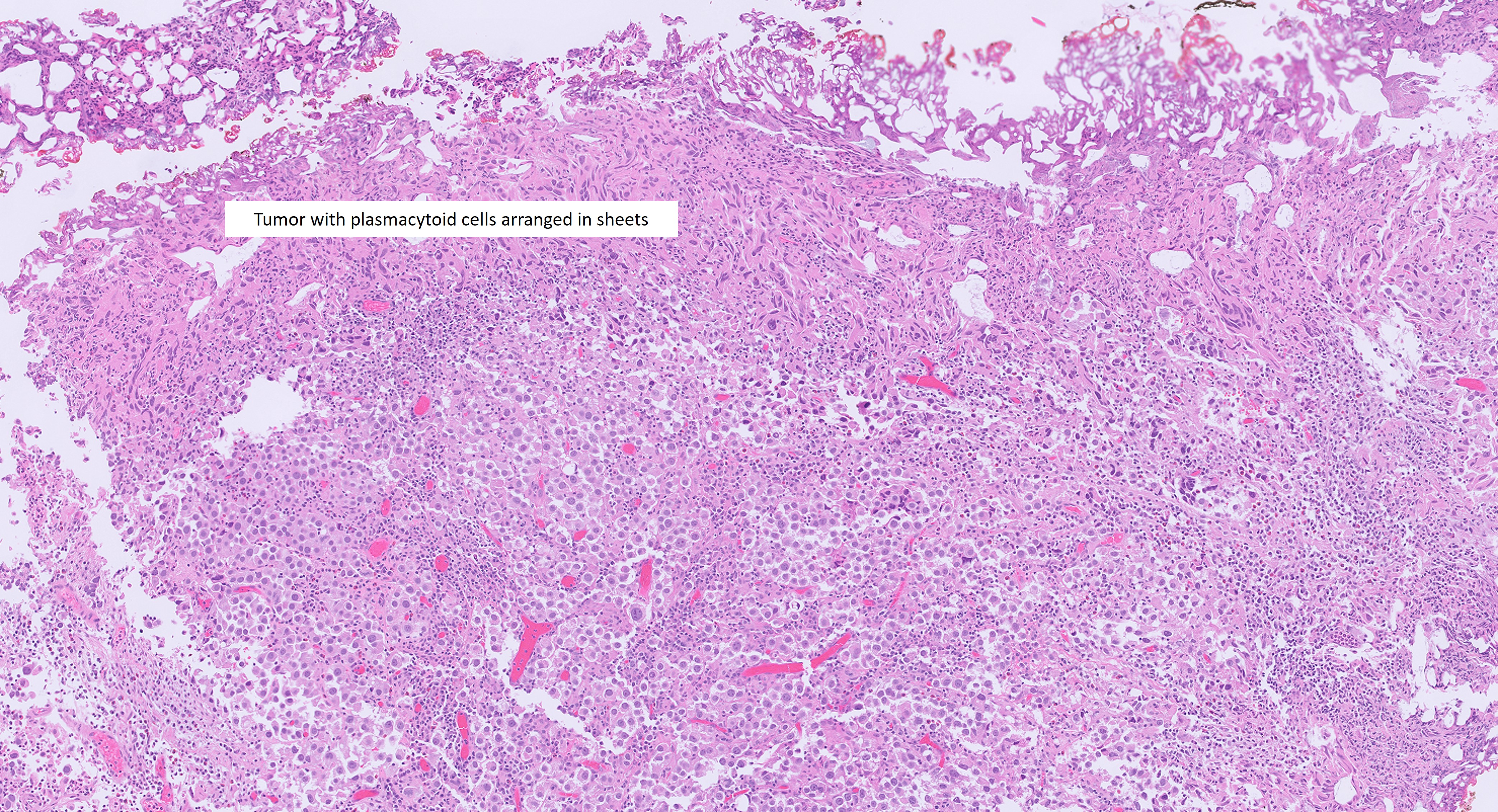 Microscopic image possibly detecting cancerous areas in human tissue