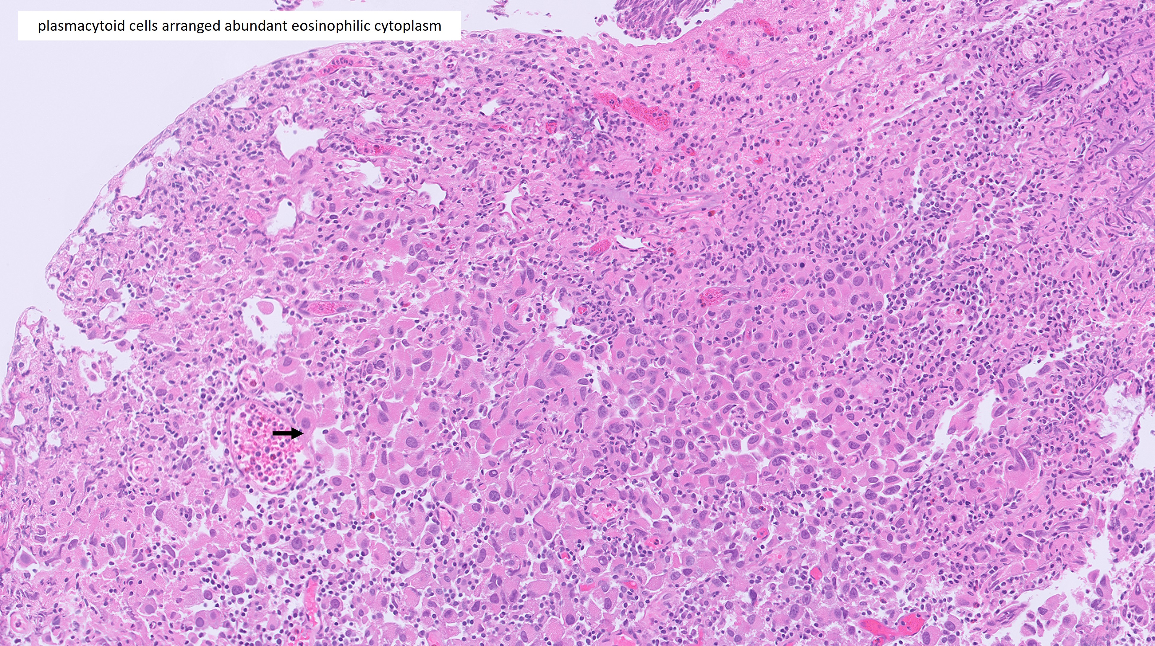 Microscopic image possibly detecting cancerous areas in human tissue