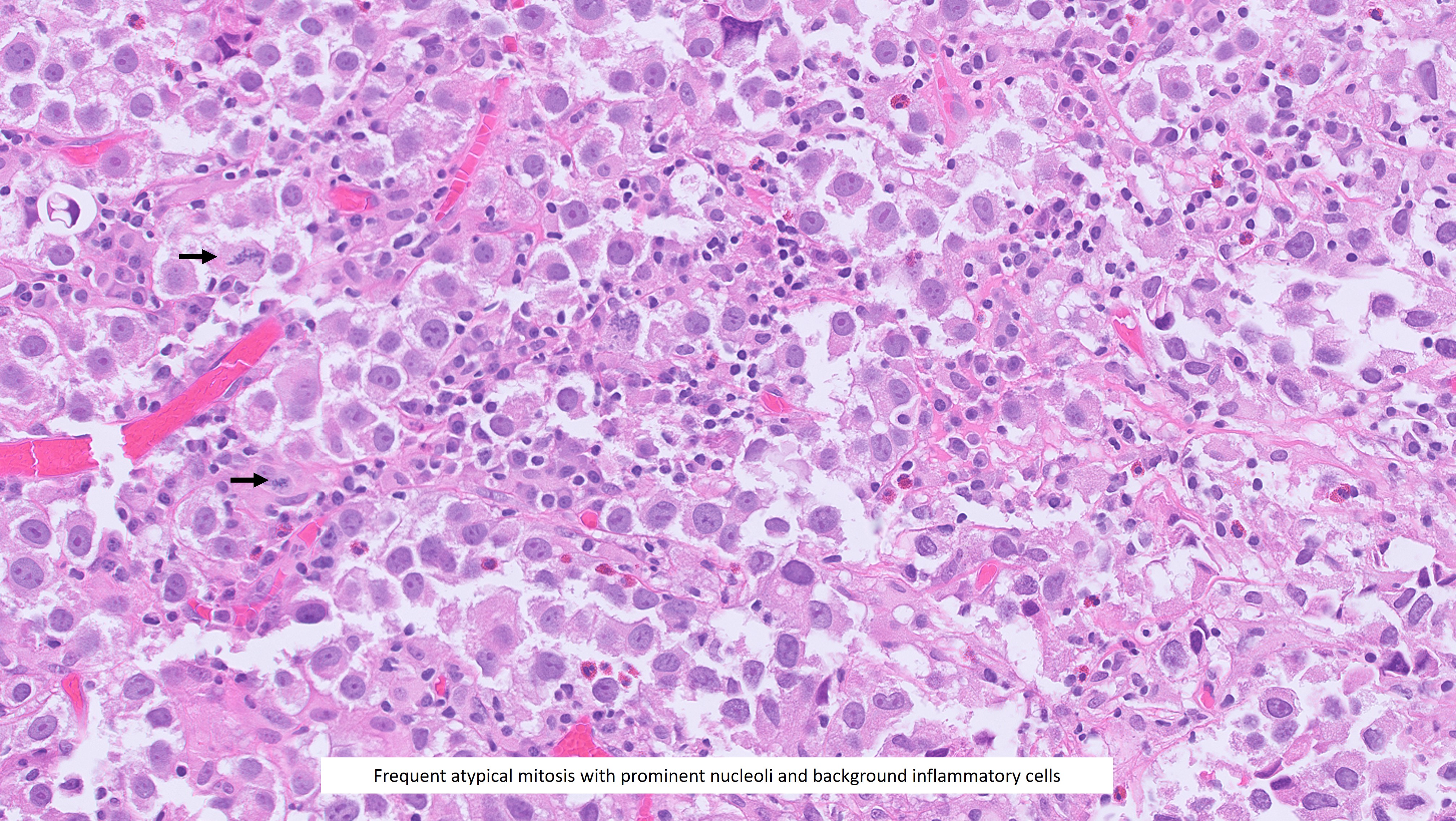 Microscopic image possibly detecting cancerous areas in human tissue