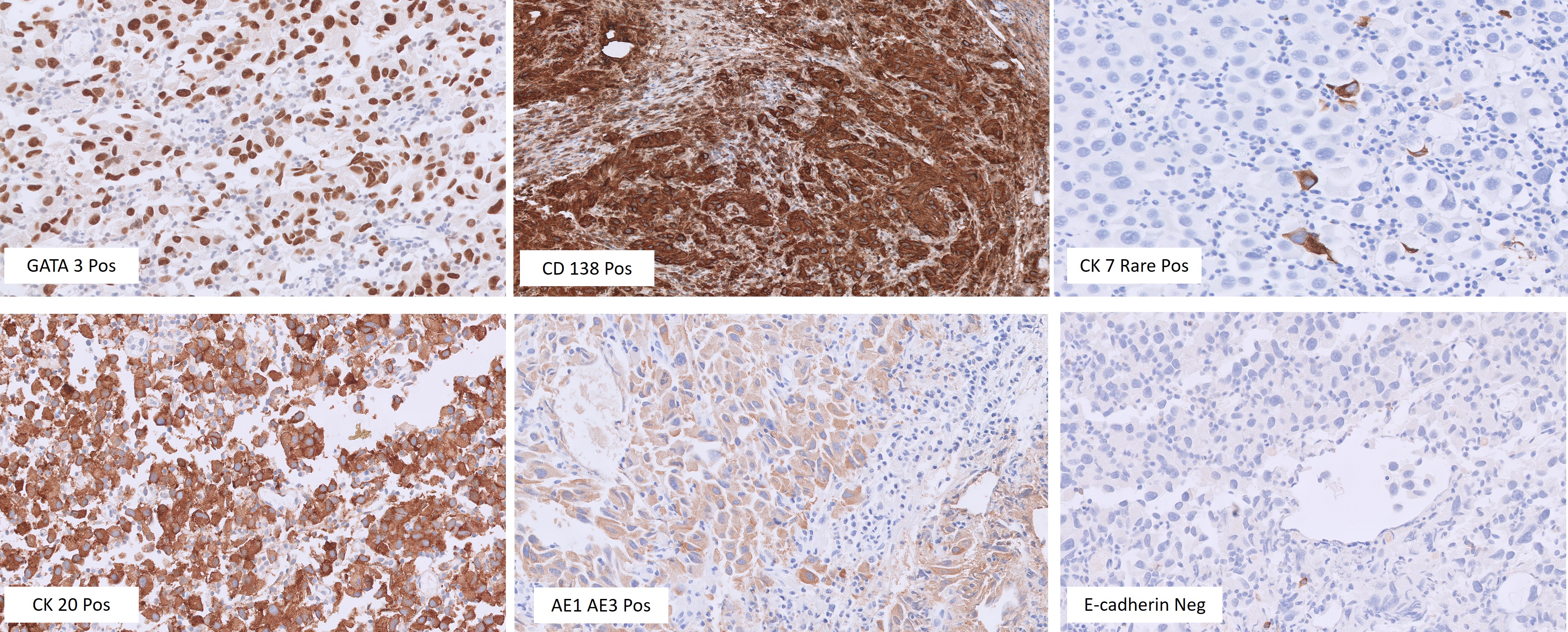 Microscopic image possibly detecting cancerous areas in human tissue