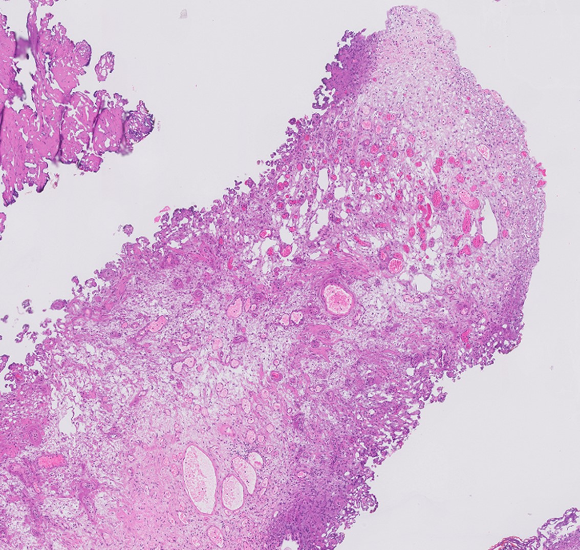 Microscopic image possibly detecting cancerous areas in human tissue