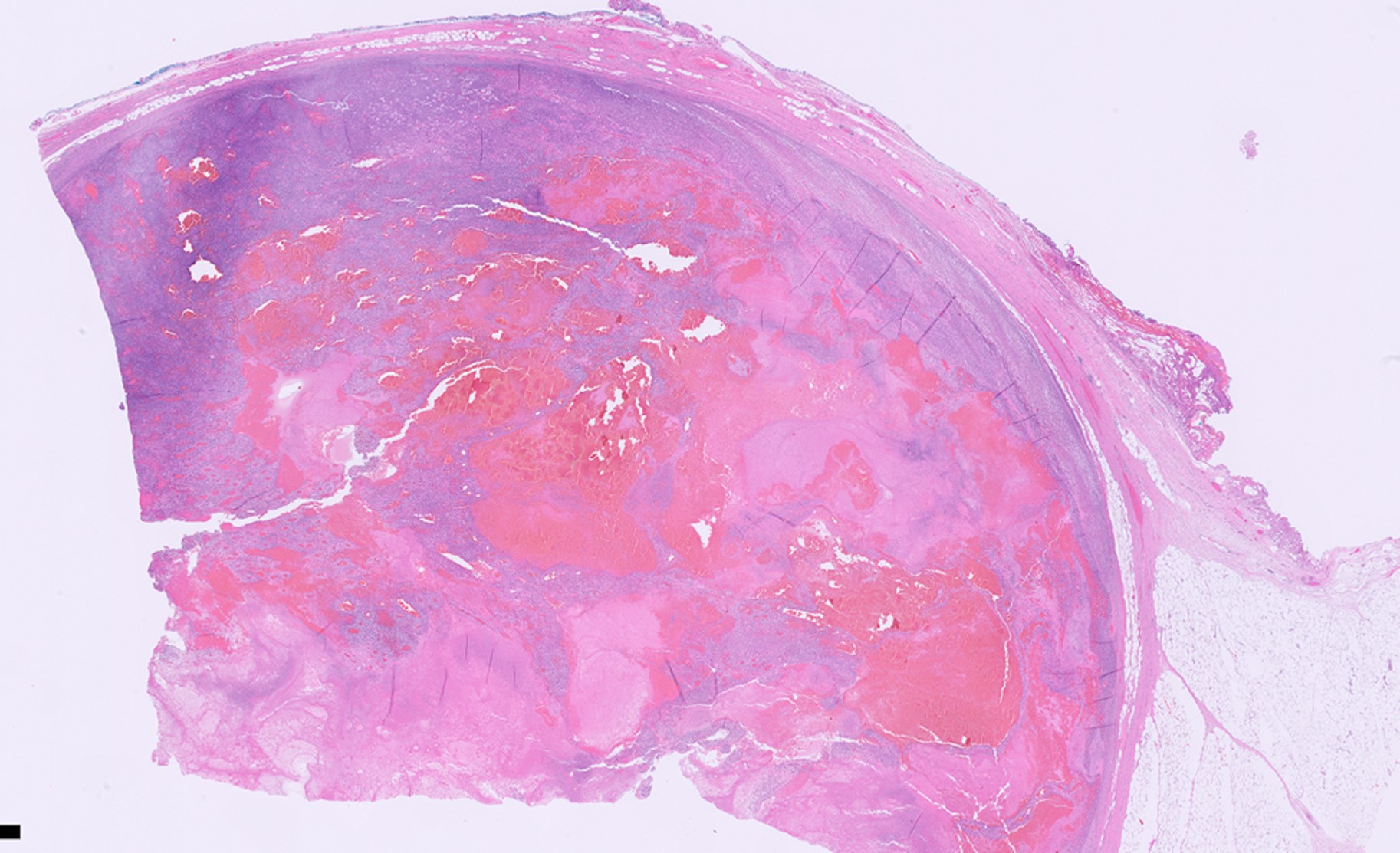 Microscopic image possibly detecting cancerous areas in human tissue