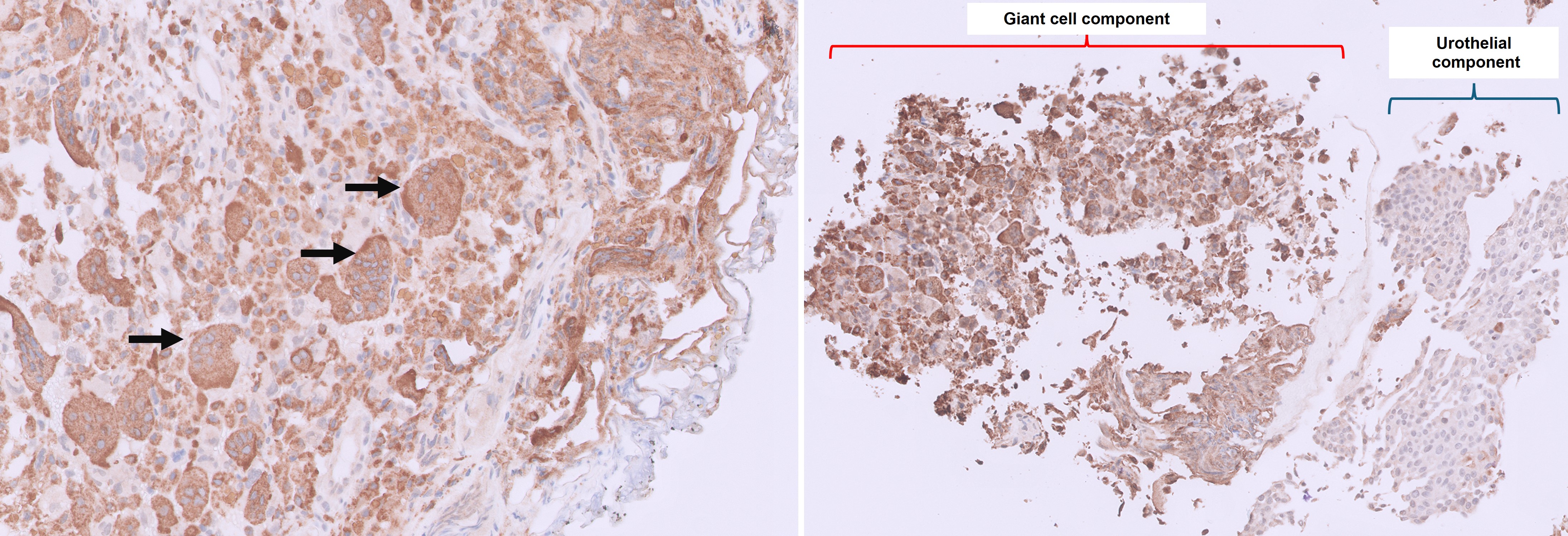 Microscopic image possibly detecting cancerous areas in human tissue