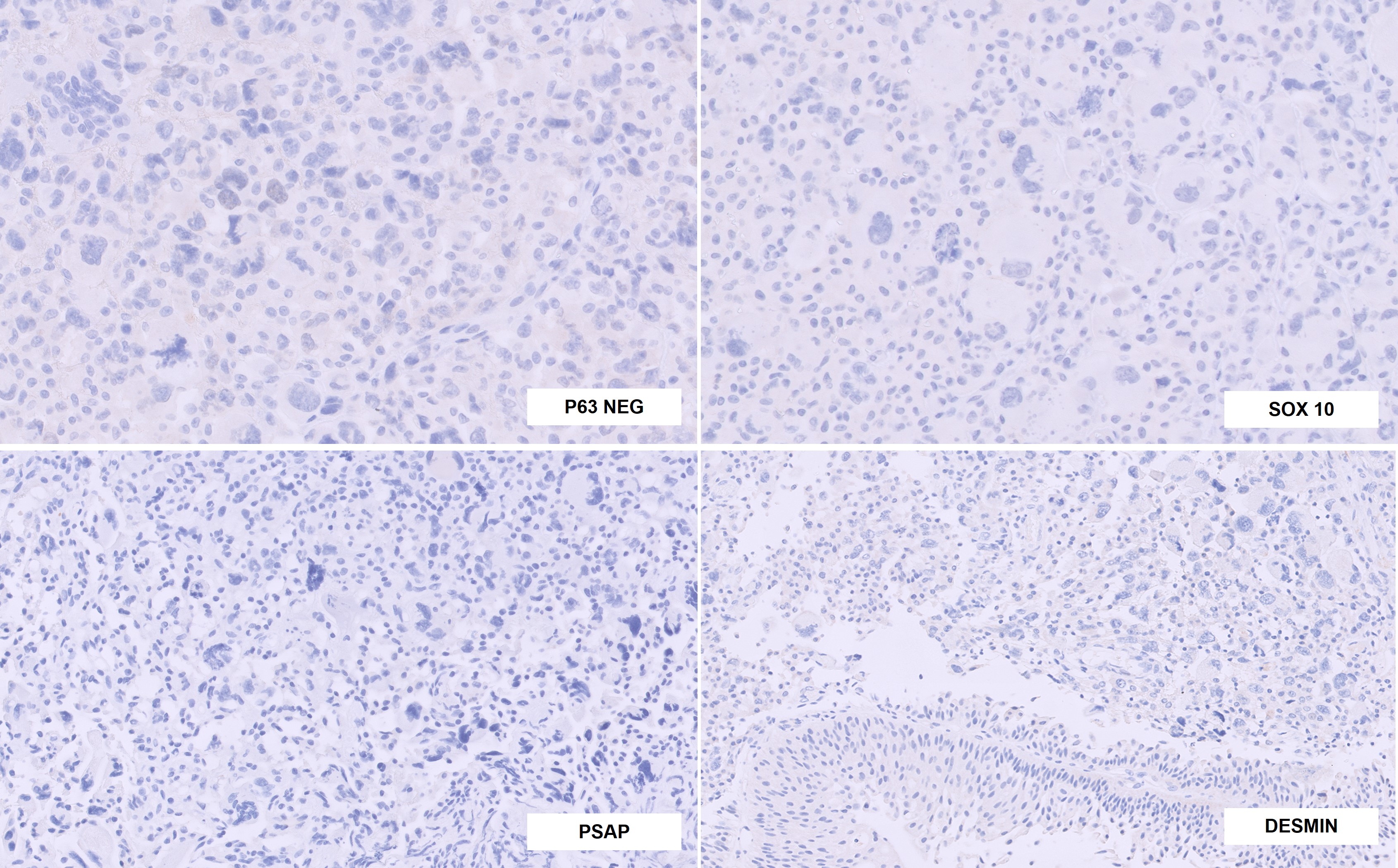 Microscopic image possibly detecting cancerous areas in human tissue