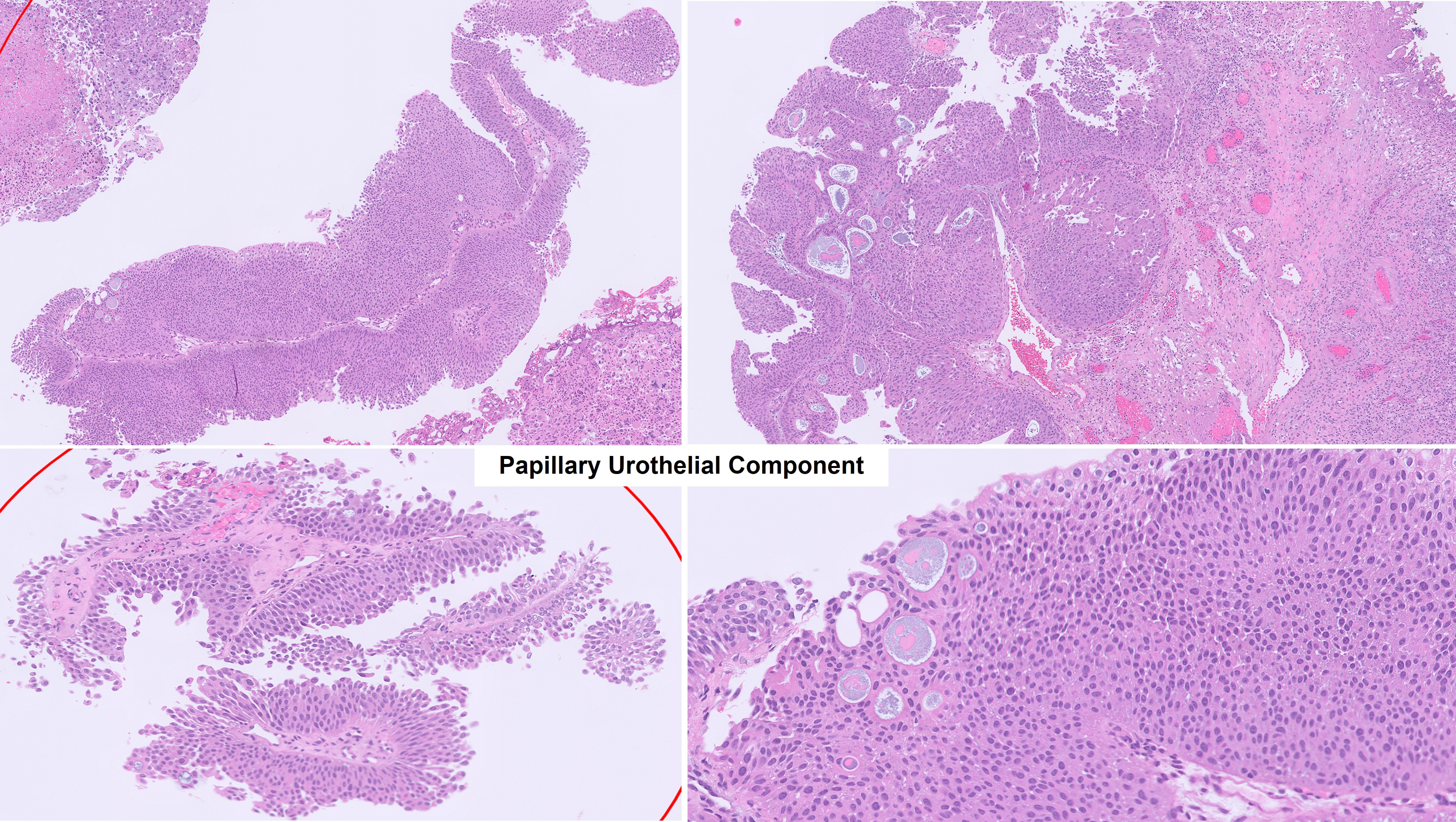 Microscopic image possibly detecting cancerous areas in human tissue