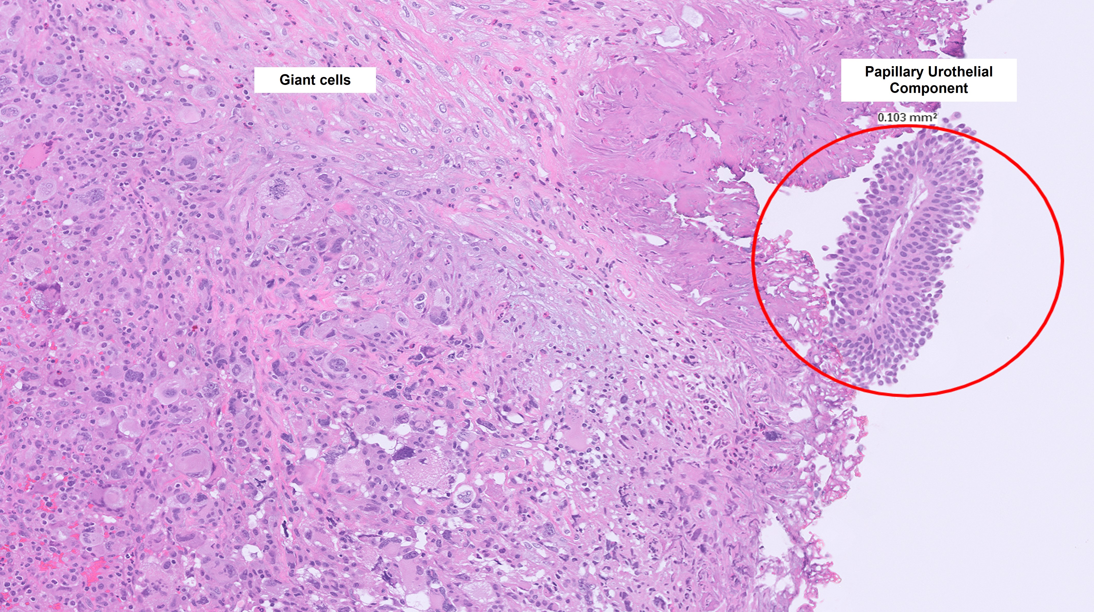 Microscopic image possibly detecting cancerous areas in human tissue