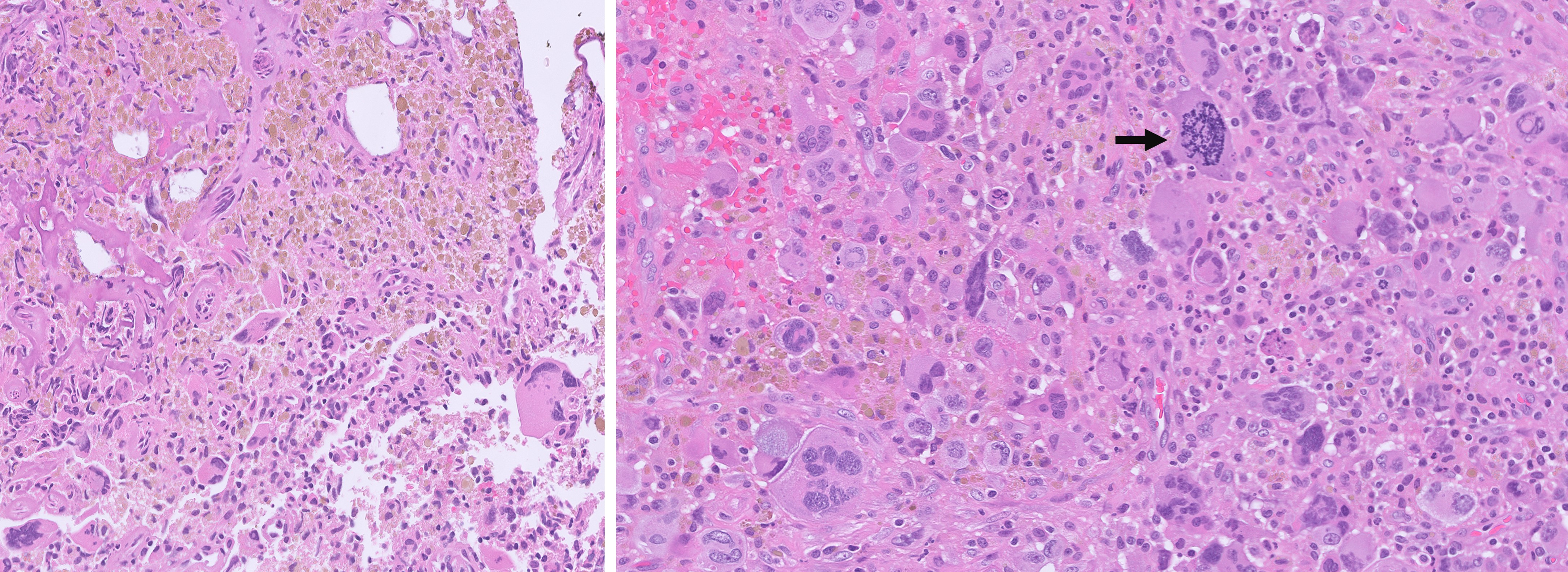 Microscopic image possibly detecting cancerous areas in human tissue