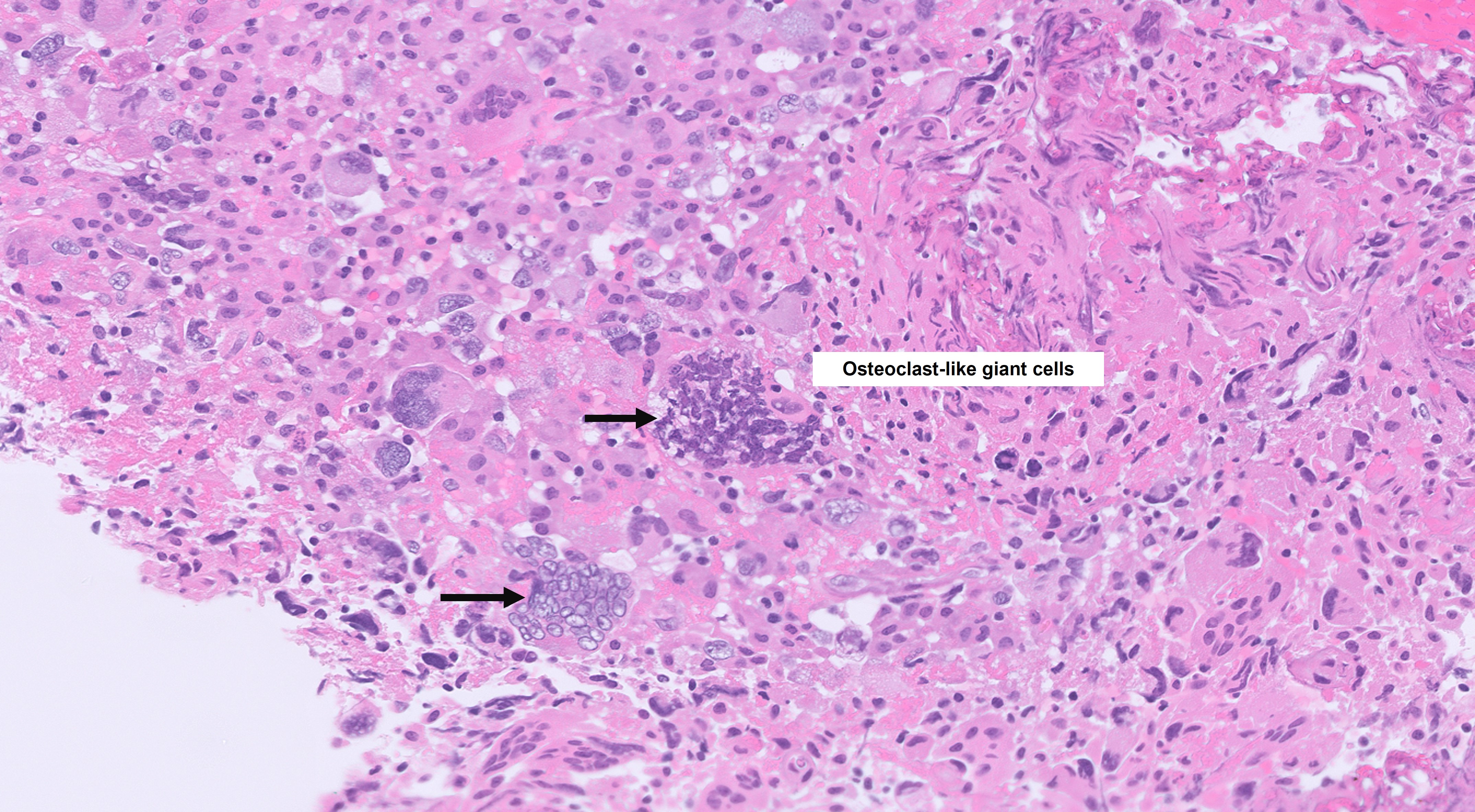 Microscopic image possibly detecting cancerous areas in human tissue