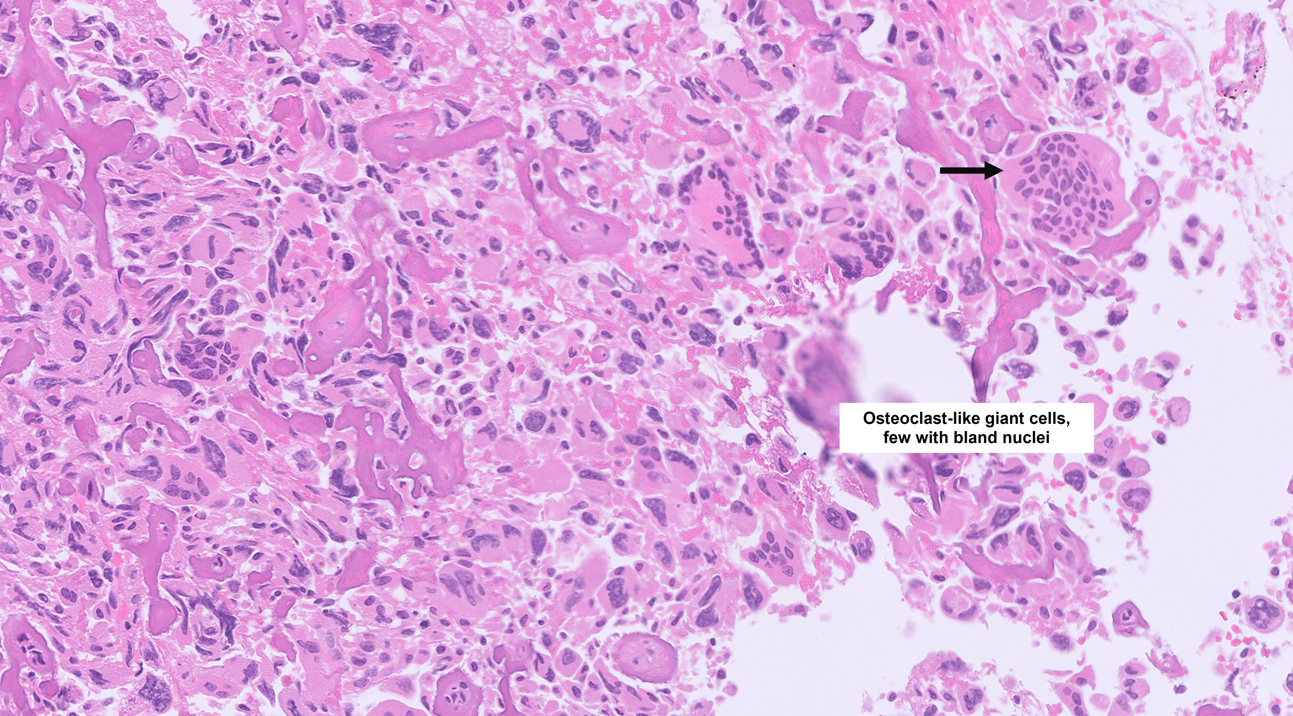 Microscopic image possibly detecting cancerous areas in human tissue