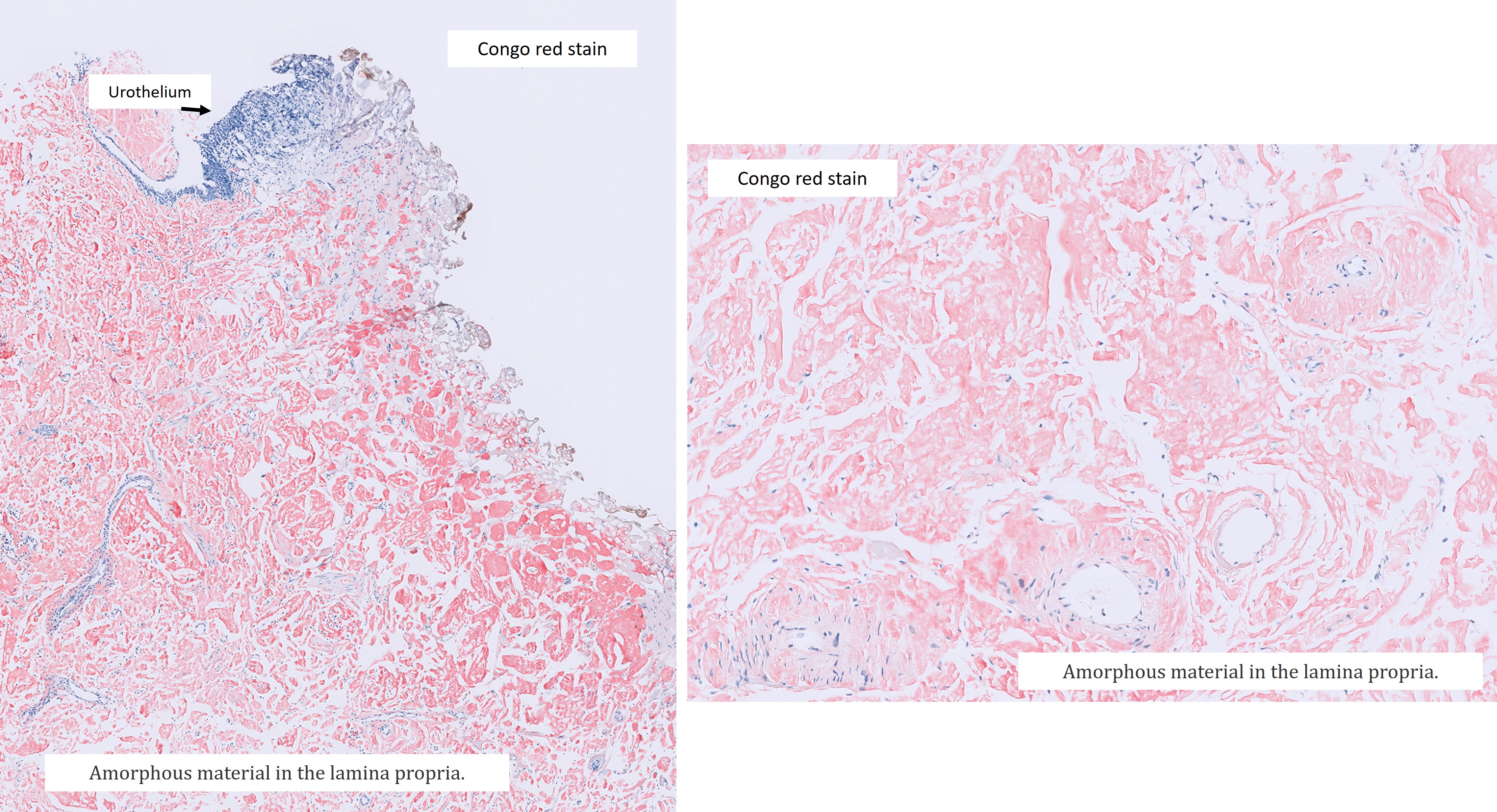 Microscopic image possibly detecting cancerous areas in human tissue