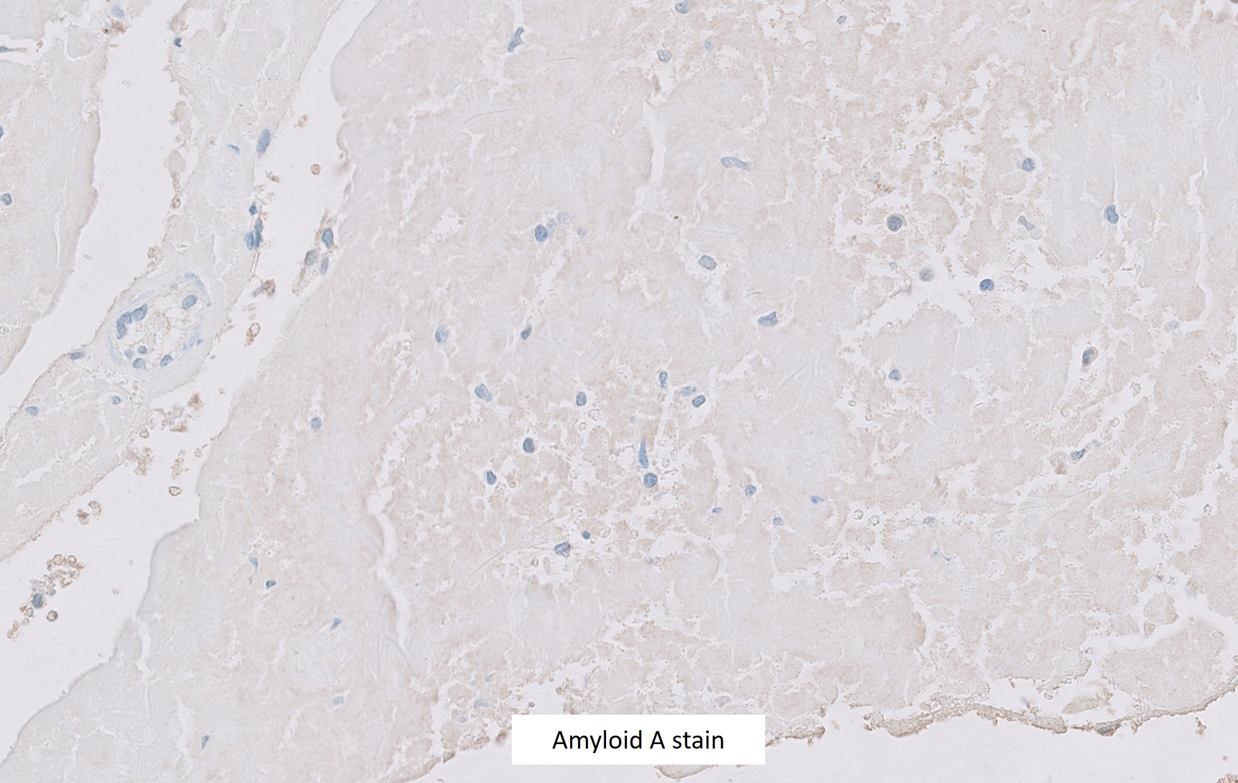 Microscopic image possibly detecting cancerous areas in human tissue