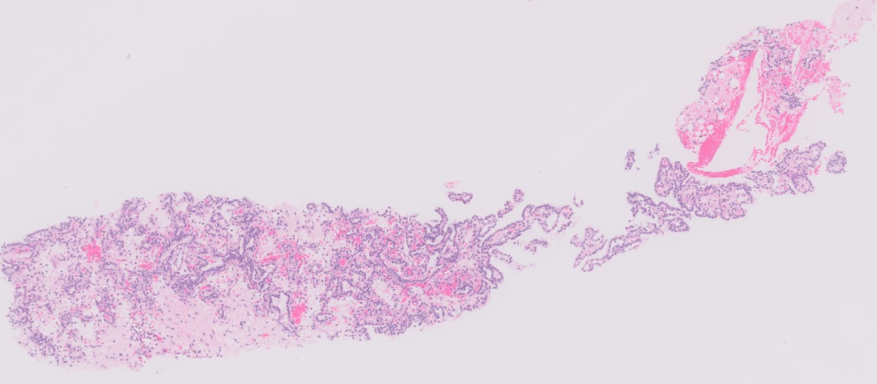 Microscopic image possibly detecting cancerous areas in human tissue