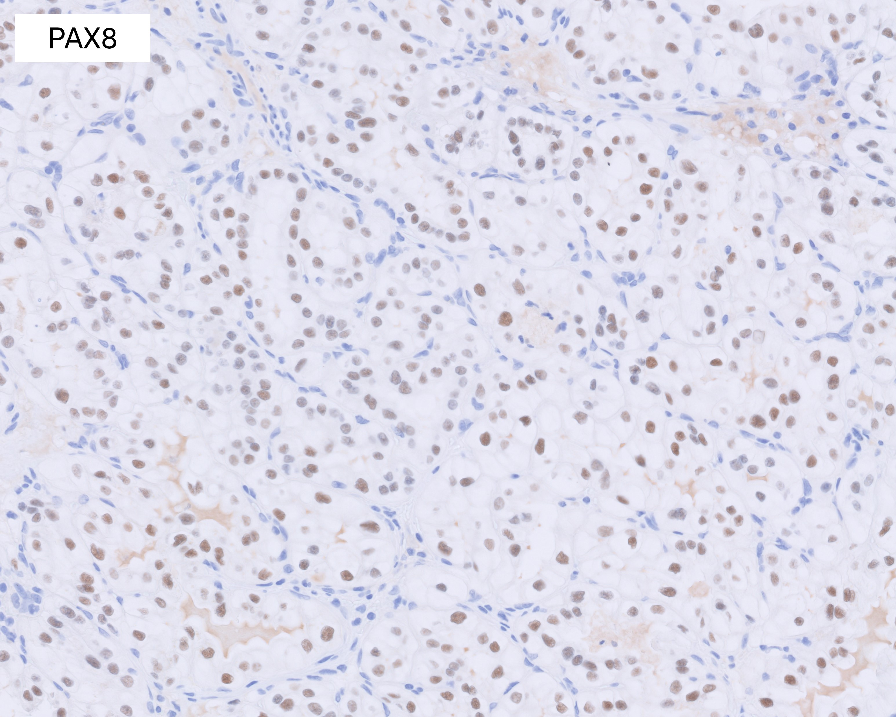 Microscopic image possibly detecting cancerous areas in human tissue