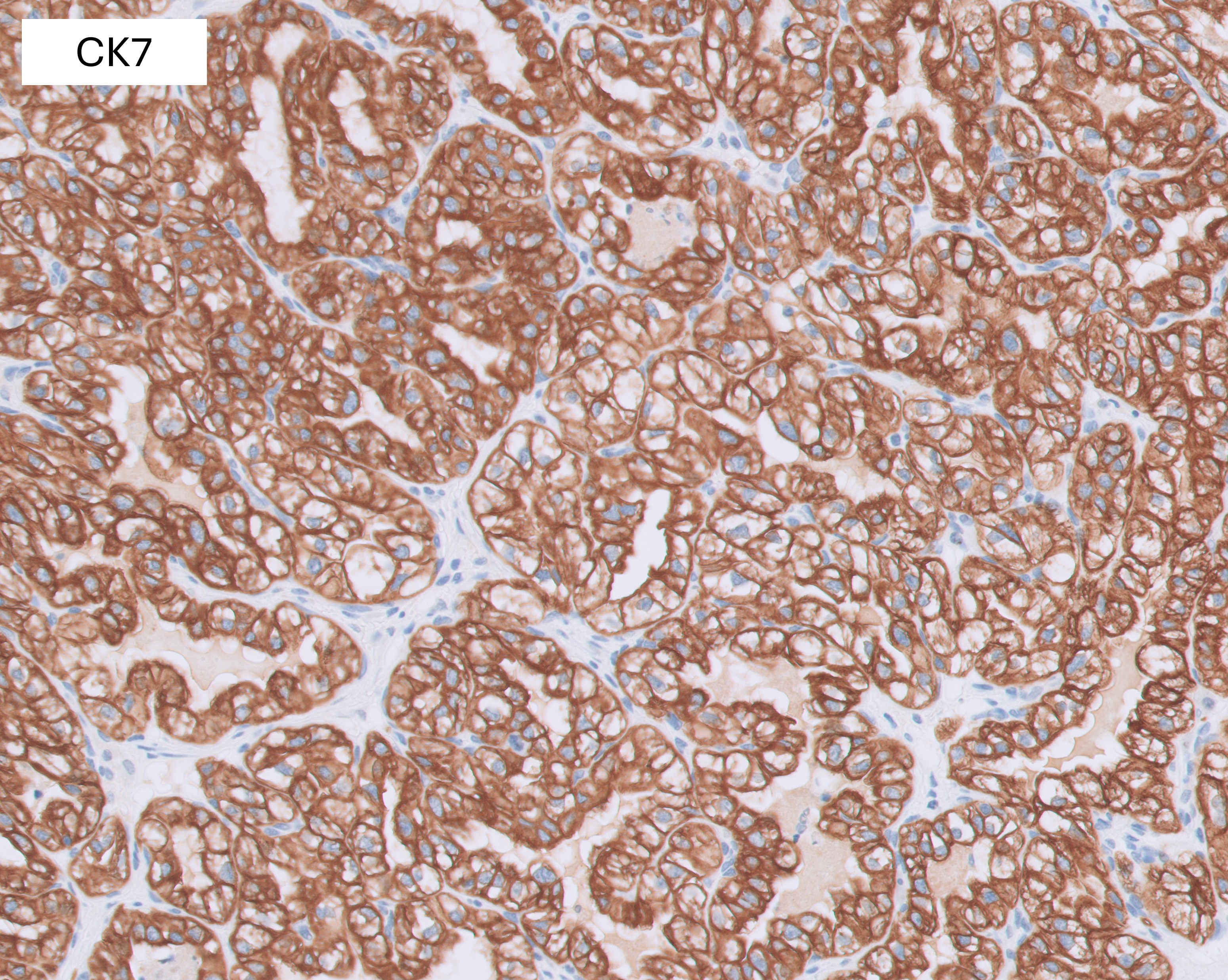 Microscopic image possibly detecting cancerous areas in human tissue