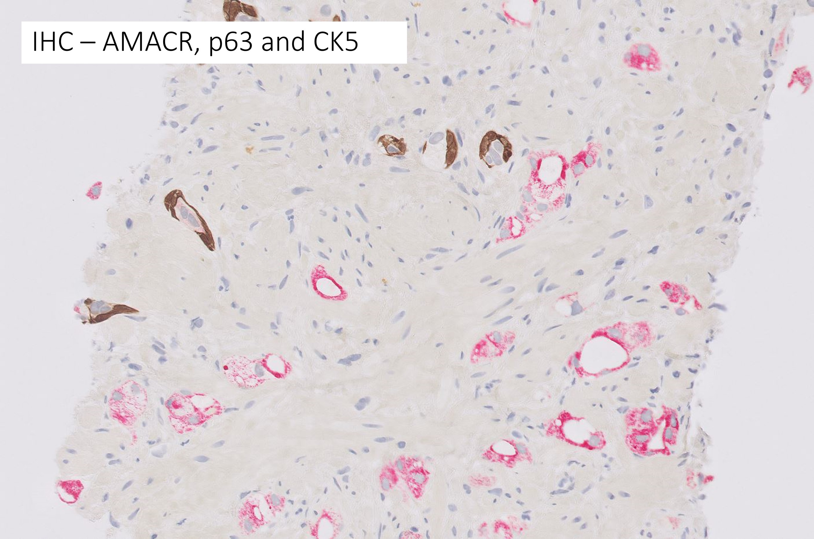 Microscopic image possibly detecting cancerous areas in human tissue