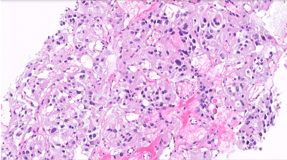 Microscopic image possibly detecting cancerous areas in human tissue