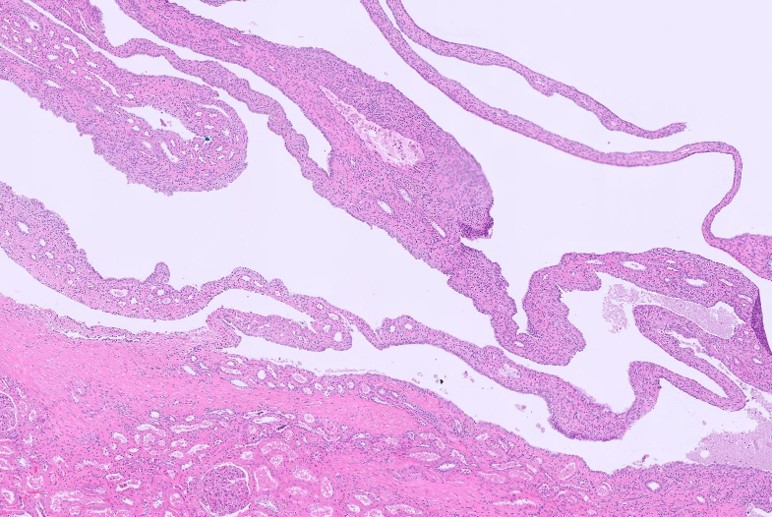 Microscopic image possibly detecting cancerous areas in human tissue