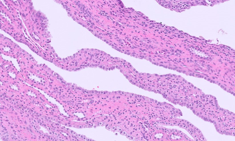 Microscopic image possibly detecting cancerous areas in human tissue