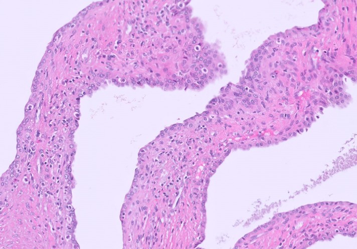 Microscopic image possibly detecting cancerous areas in human tissue