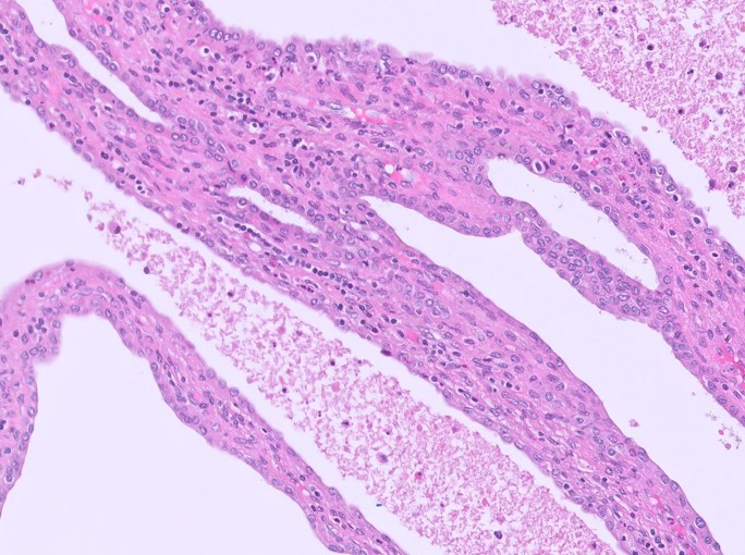Microscopic image possibly detecting cancerous areas in human tissue