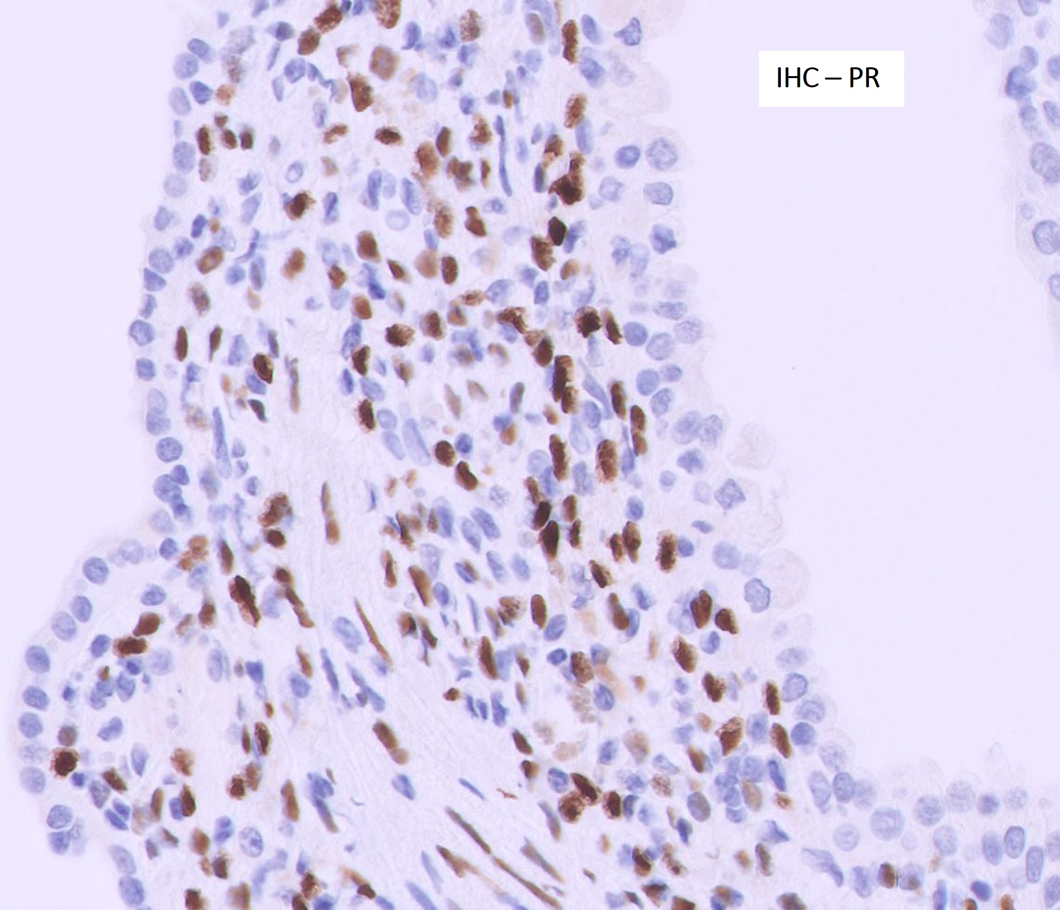 Microscopic image possibly detecting cancerous areas in human tissue
