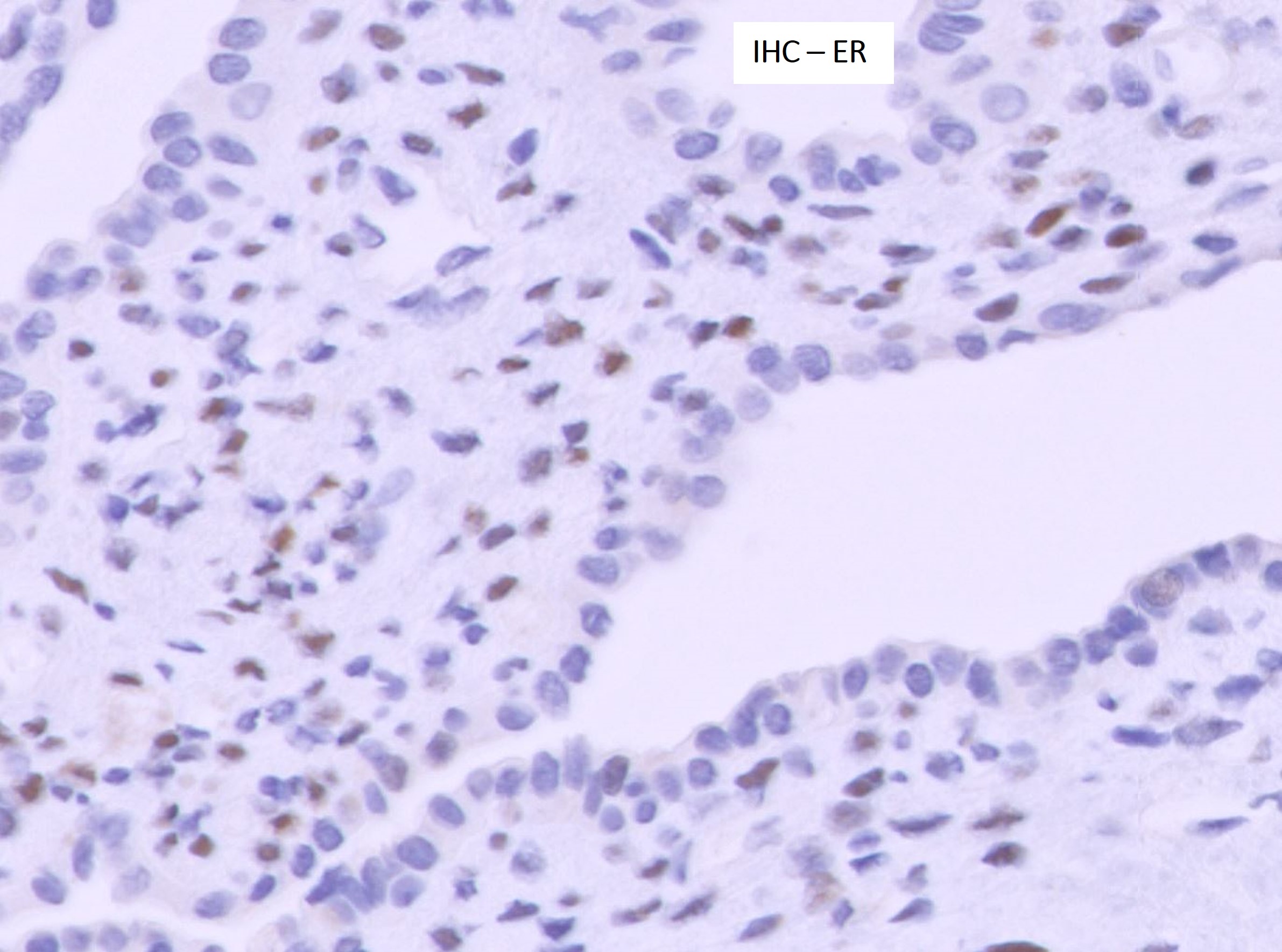 Microscopic image possibly detecting cancerous areas in human tissue