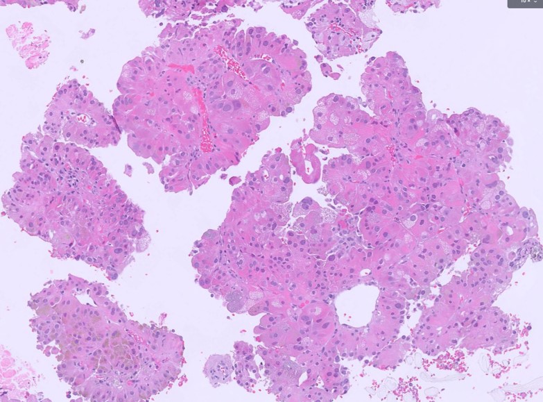 Microscopic image possibly detecting cancerous areas in human tissue