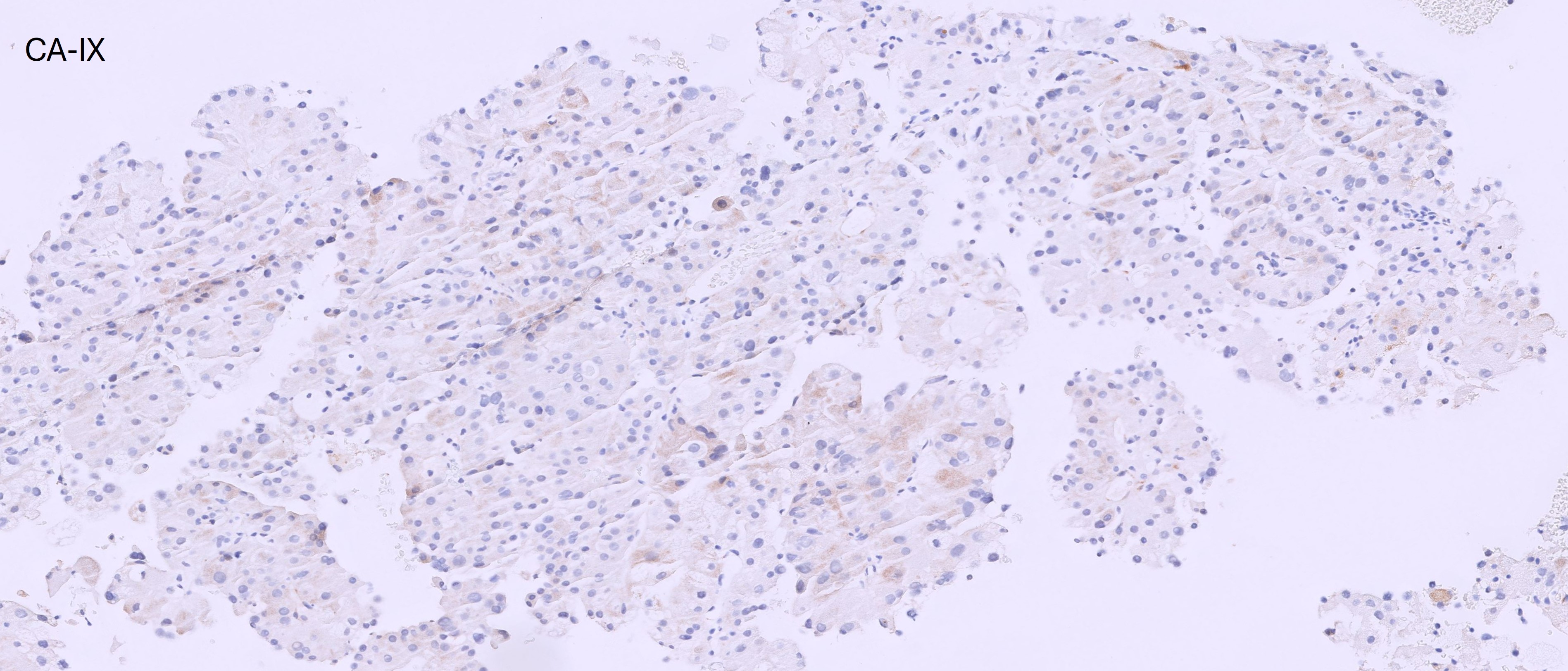 Microscopic image possibly detecting cancerous areas in human tissue