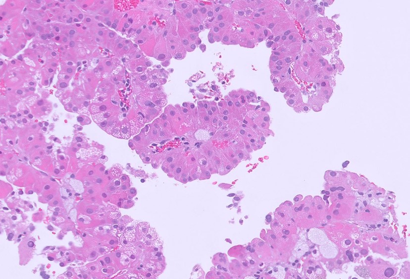 Microscopic image possibly detecting cancerous areas in human tissue
