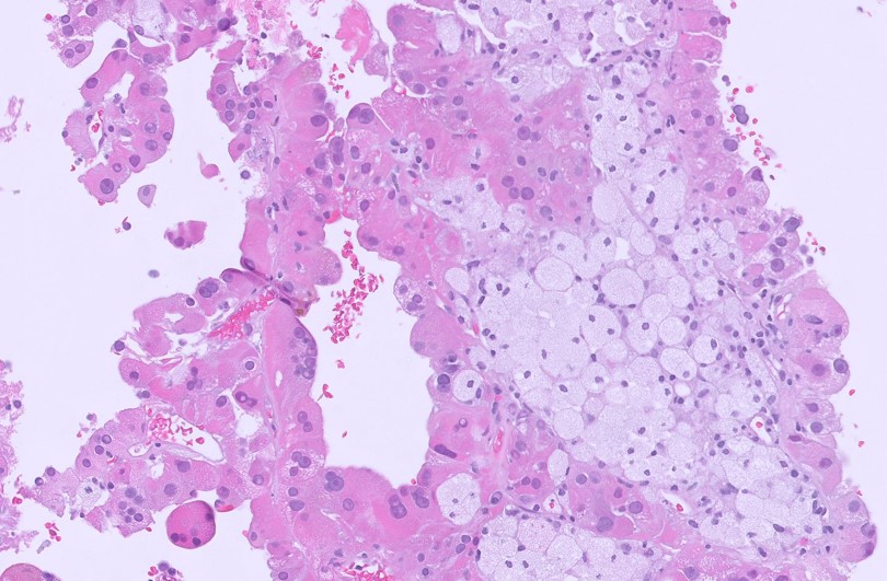 Microscopic image possibly detecting cancerous areas in human tissue