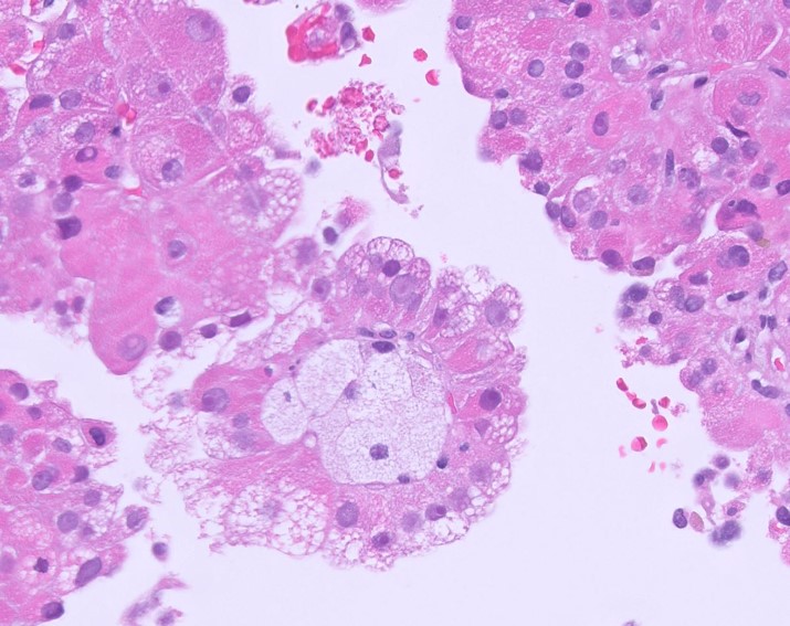 Microscopic image possibly detecting cancerous areas in human tissue