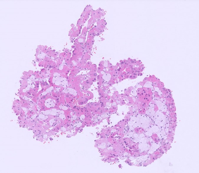 Microscopic image possibly detecting cancerous areas in human tissue